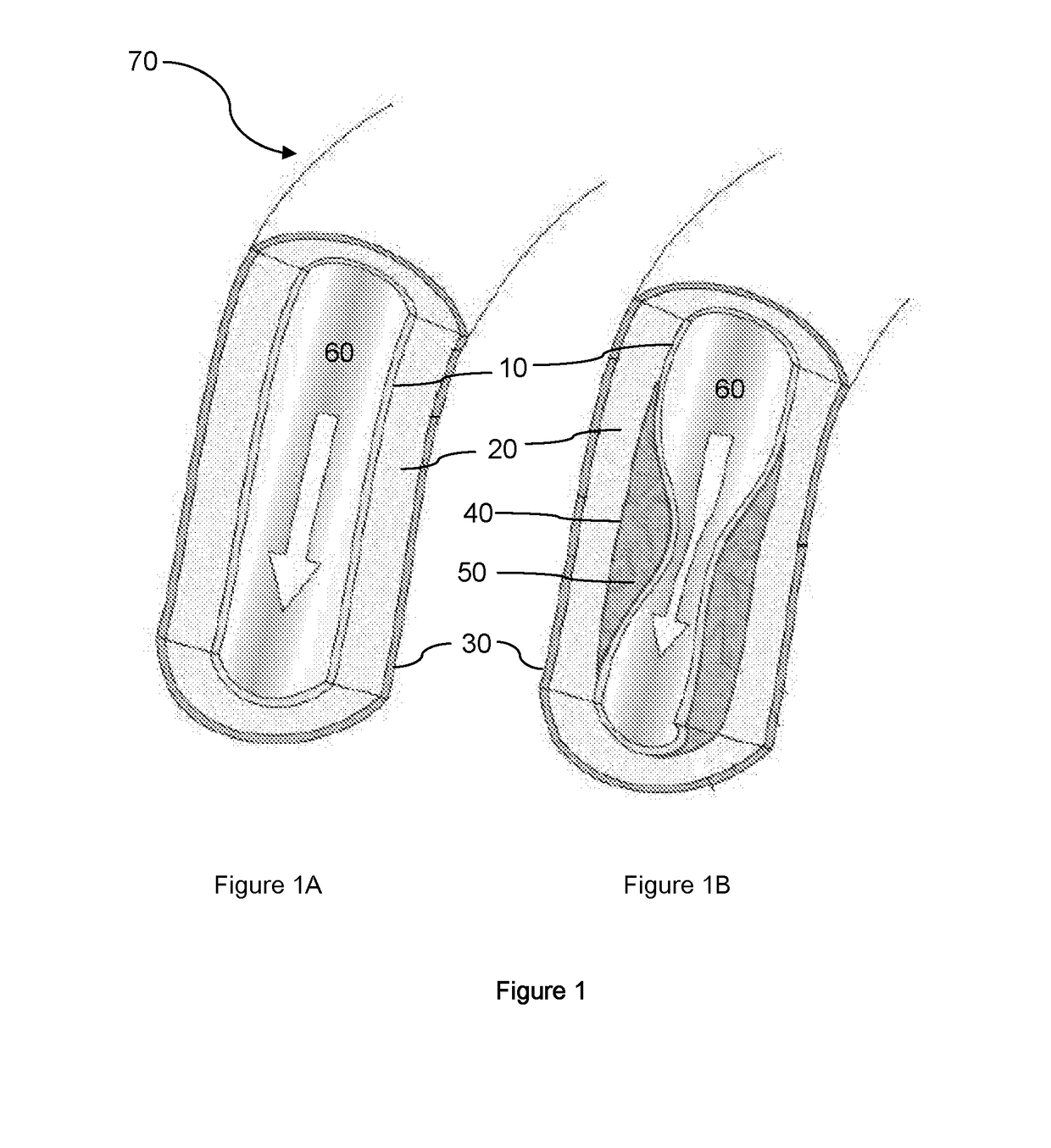 A system and method for treating artery