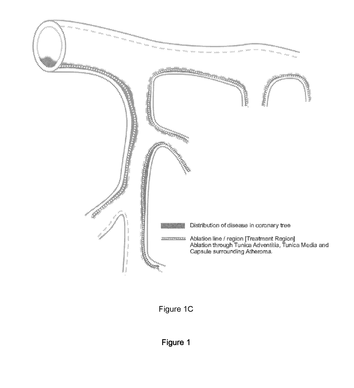 A system and method for treating artery