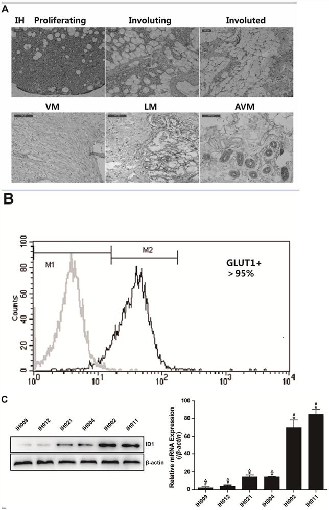 A product for evaluating the effect of propranolol in the treatment of infantile hemangioma