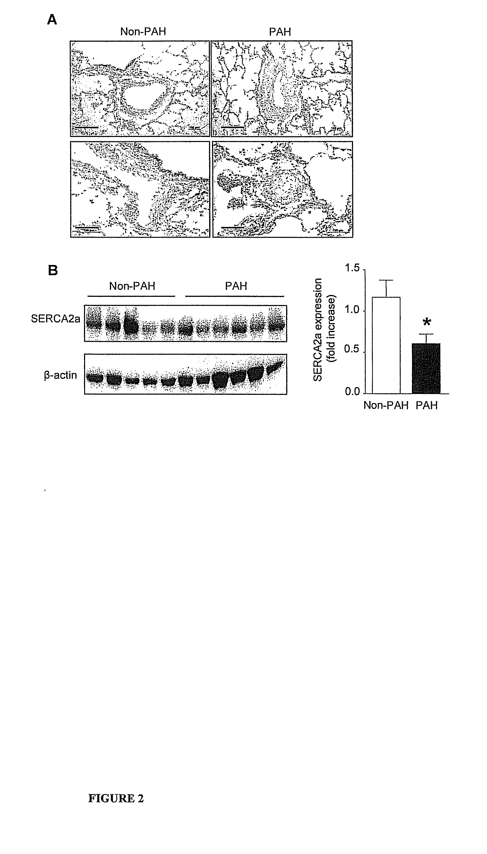 Serca2 therapeutic compositions and methods of use
