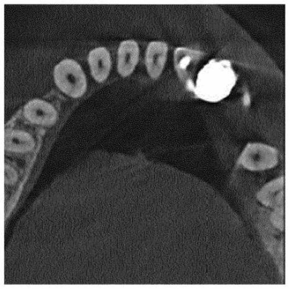 Method of metal artefact reduction in x-ray dental volume tomography