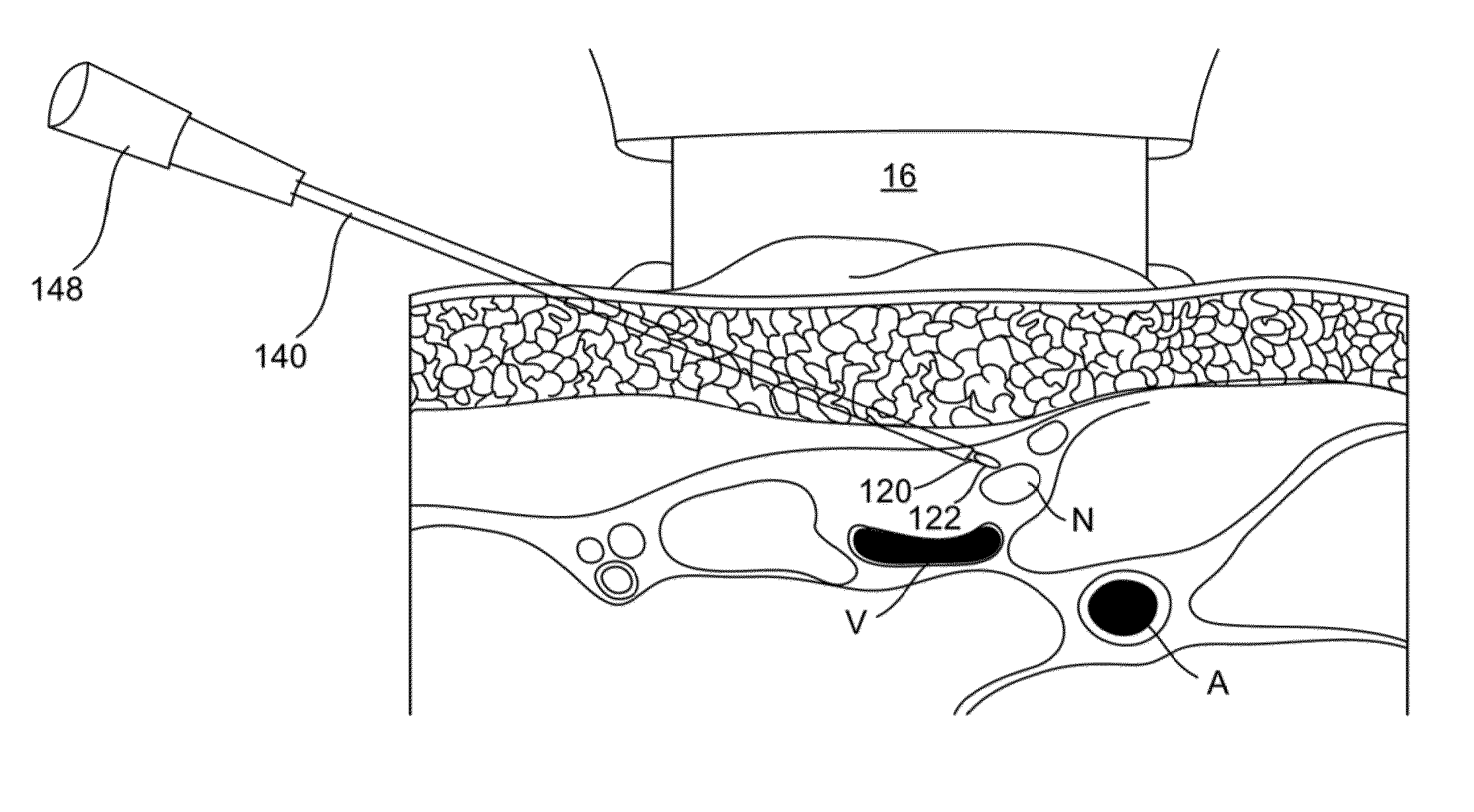 Neuro-vasculature access system and device