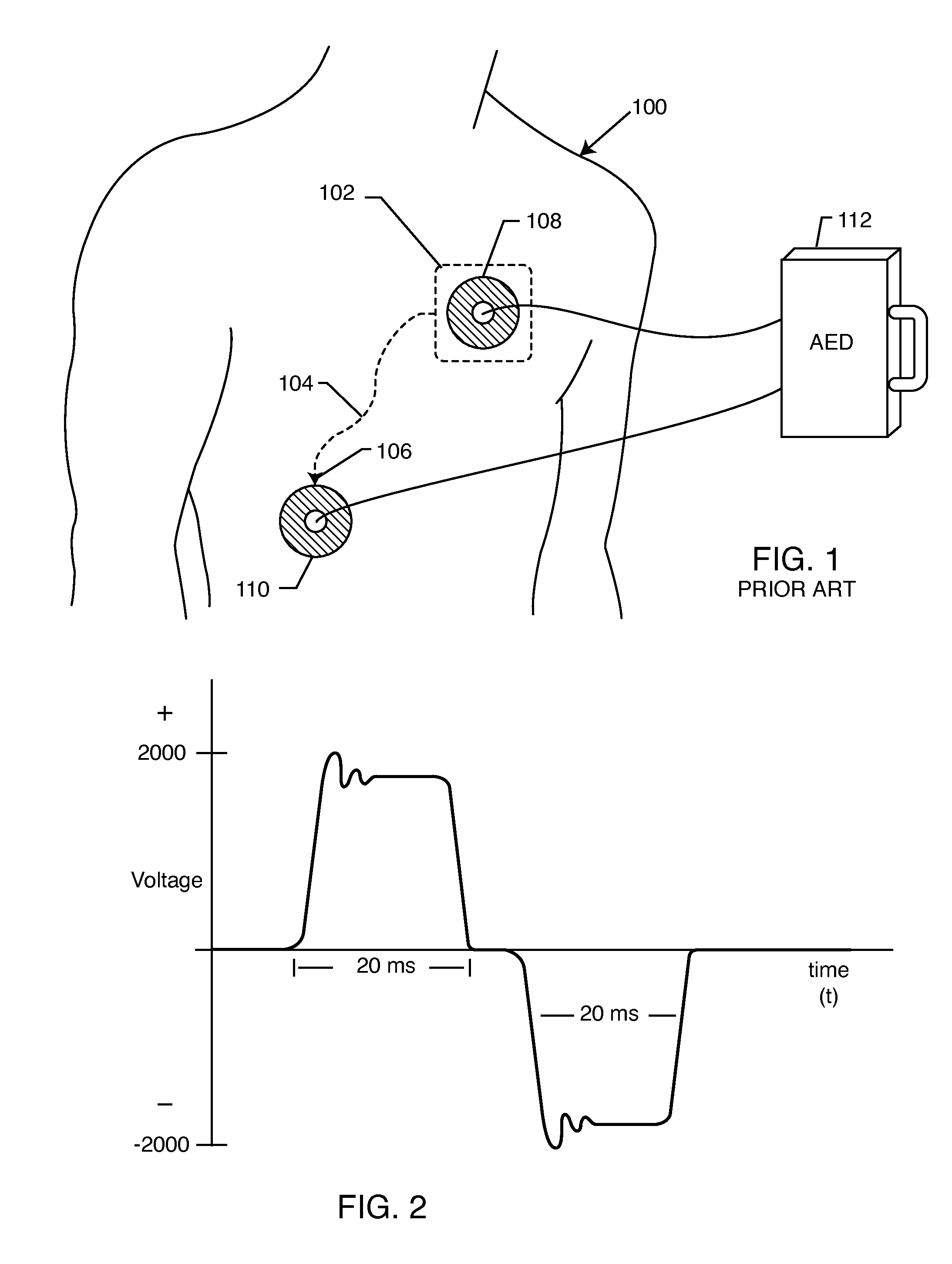Transient voltage suppression circuit for an implanted RFID chip