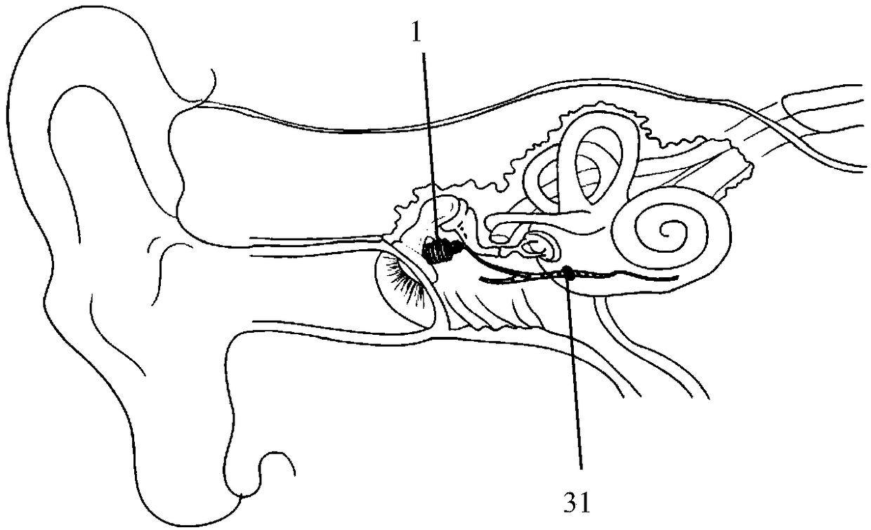 Middle ear repeated dosing device and artificial cochlea implanted electrode