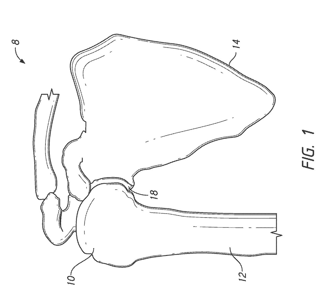Guides and instruments for improving accuracy of glenoid implant placement