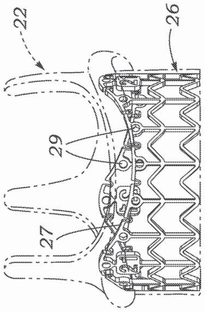 Heart valve sealing assemblies