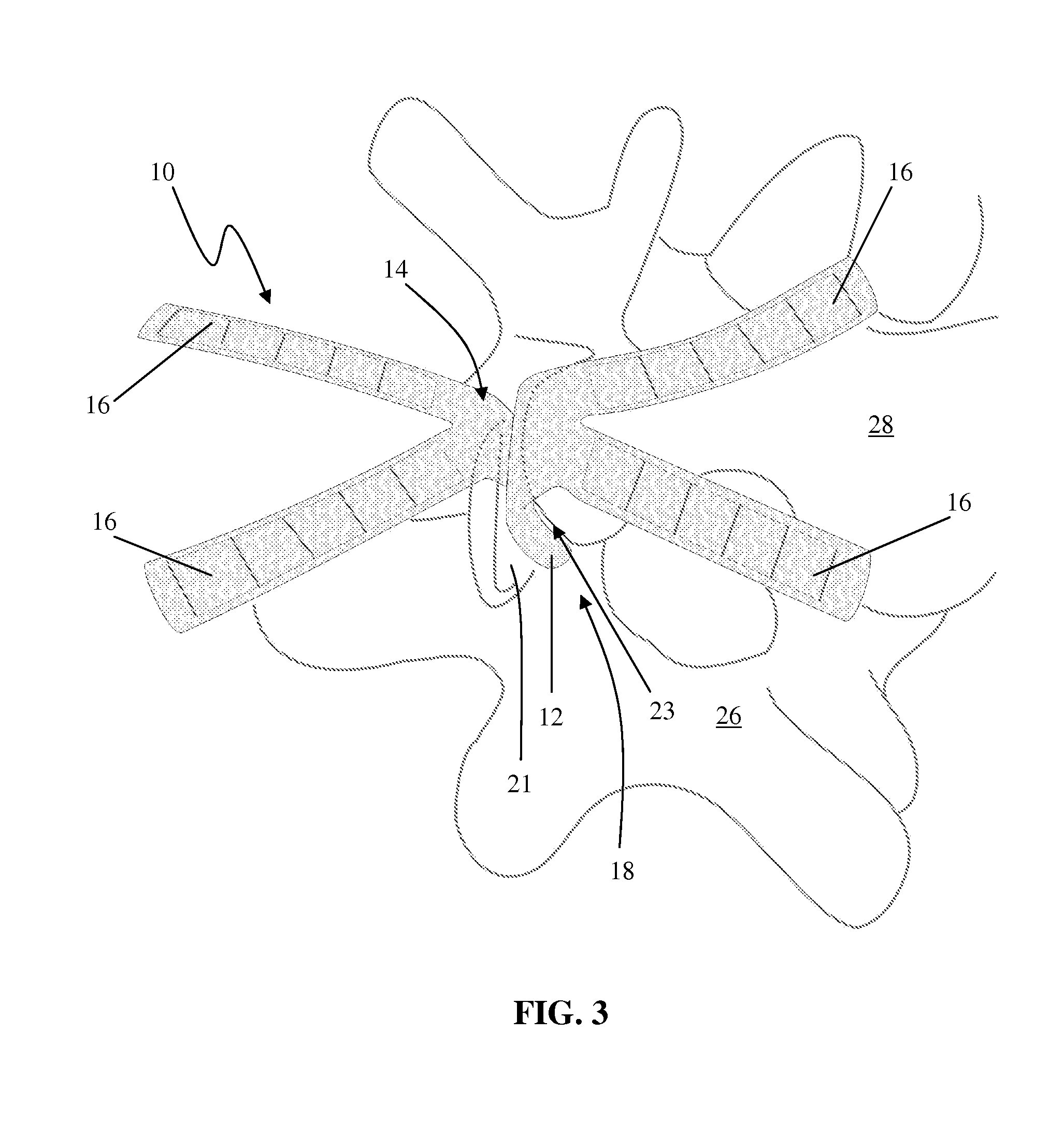 Facet Joint Implant and Related Methods