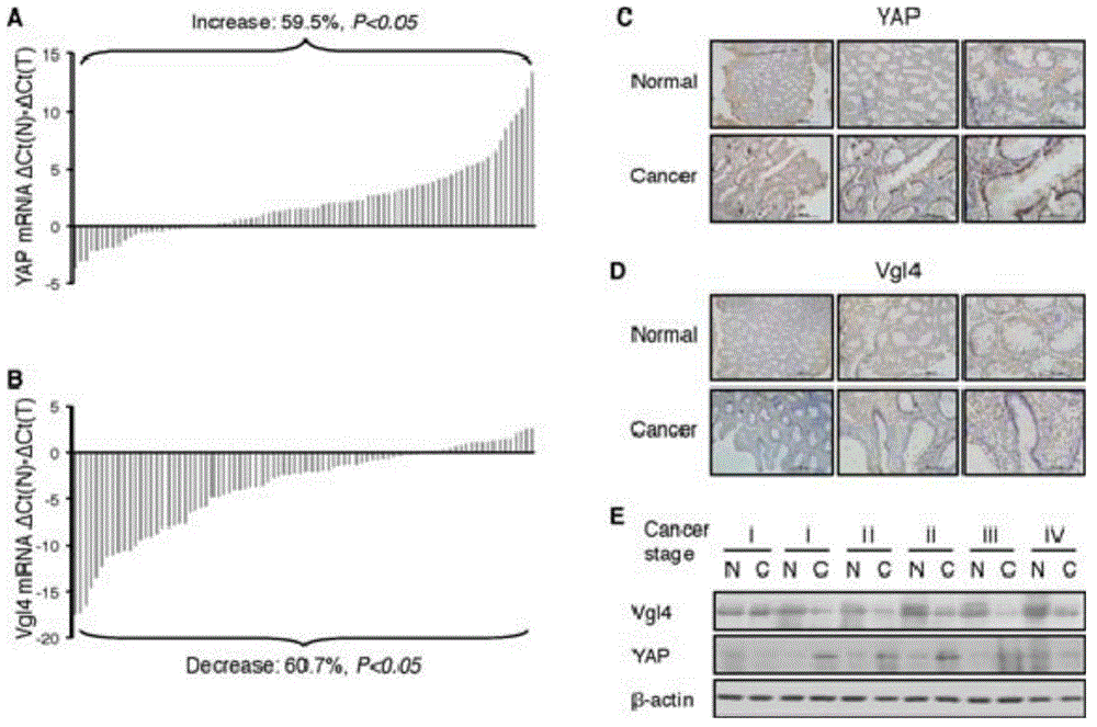 Application of VGLL4 gene in treatment of tumors and related medicament of VGLL4 gene