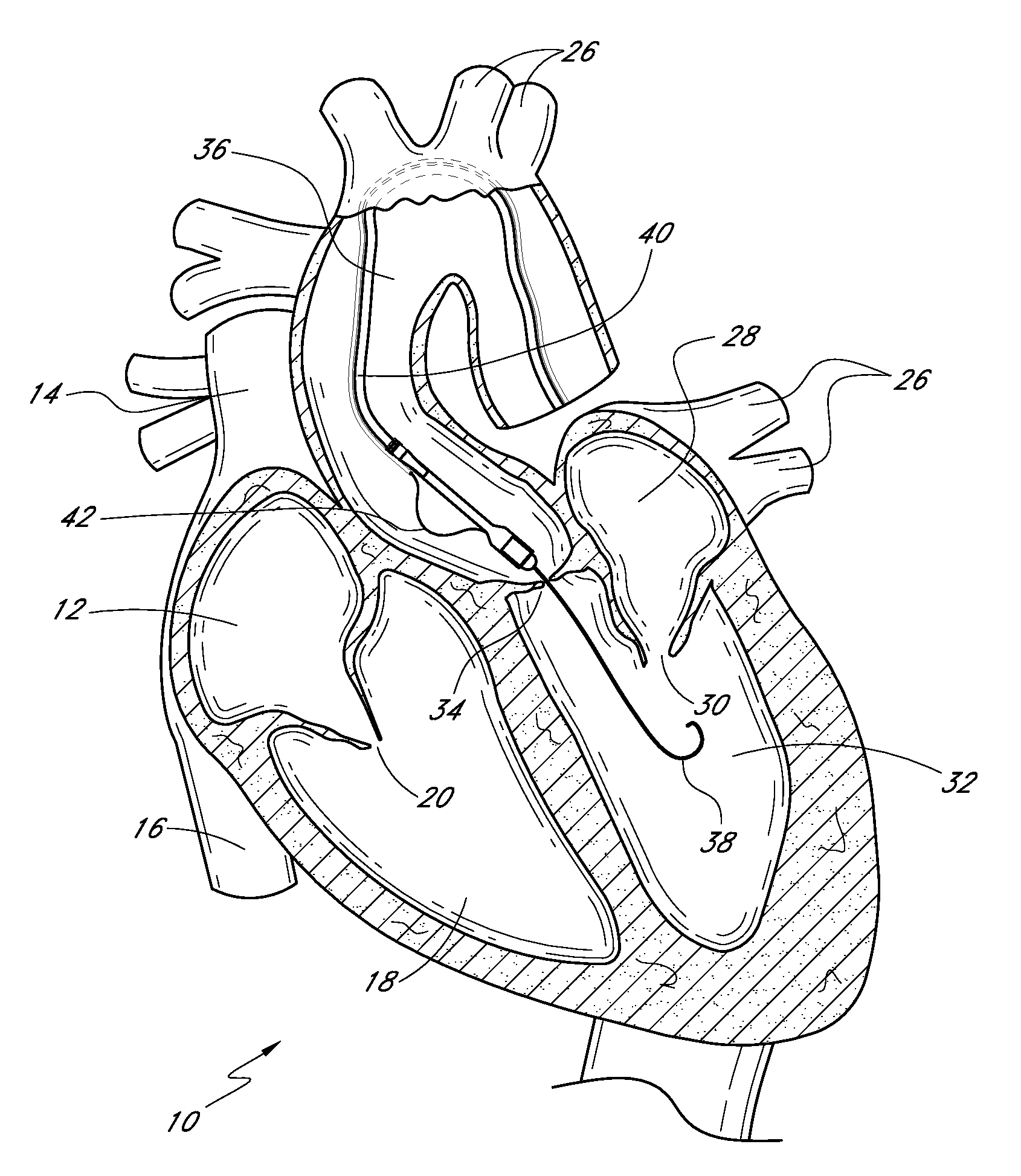 Catheter guidance through a calcified aortic valve