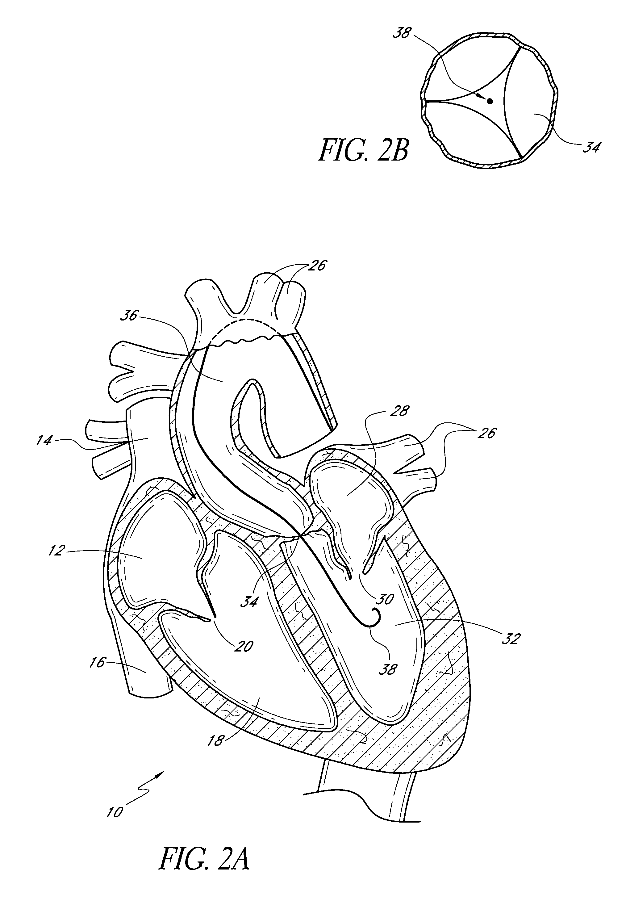 Catheter guidance through a calcified aortic valve