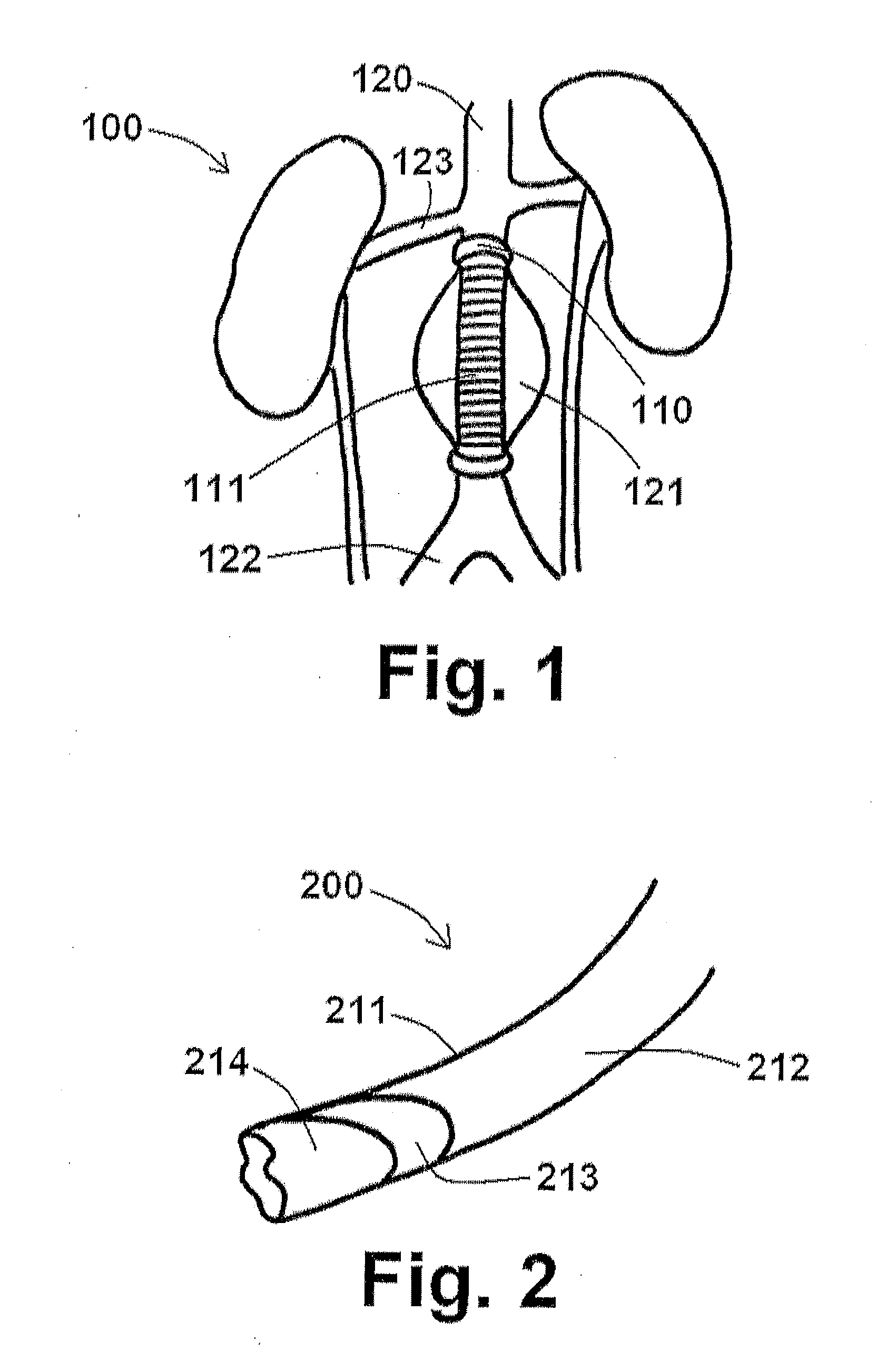 Endoprosthesis assemblies and methods for using the same