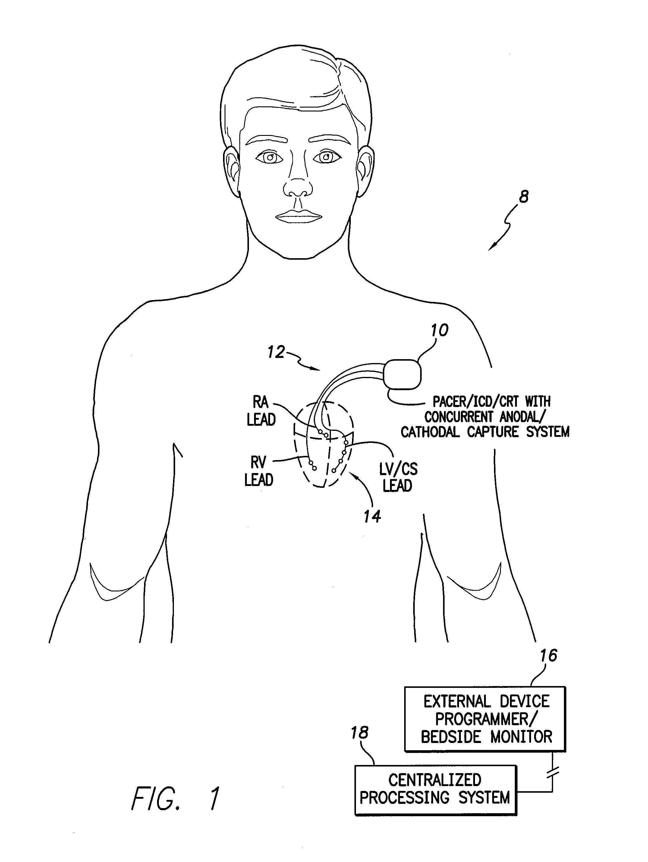 Systems and methods for assessing and exploiting concurrent cathodal and anodal capture using an implantable medical device