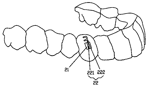 Composite device for simultaneously realizing front traction of maxilla and orthodontic tooth three-dimensional movement