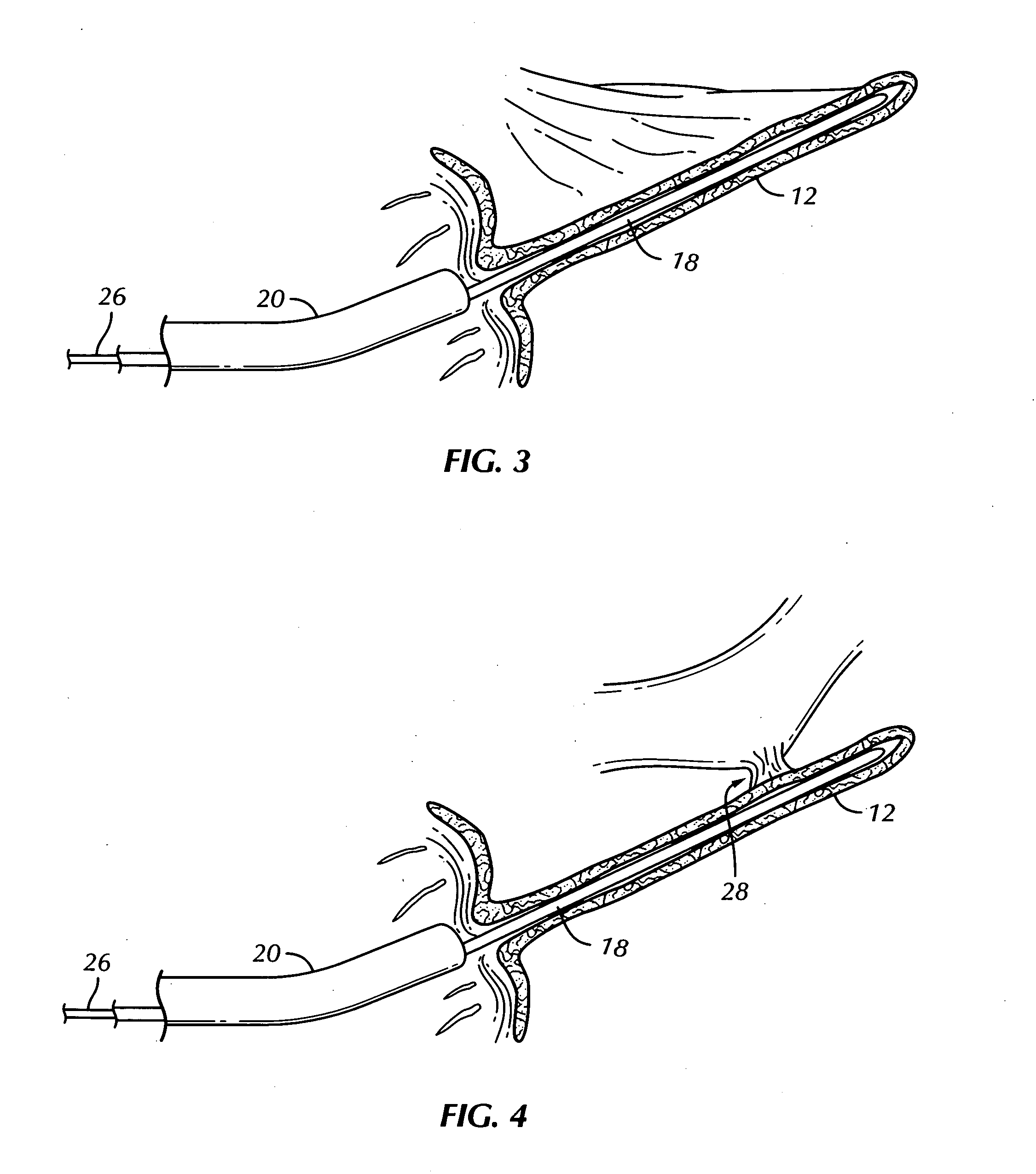 Systems and methods for less invasive resolution of maladies of tissue including the appendix, gall bladder, and hemorrhoids