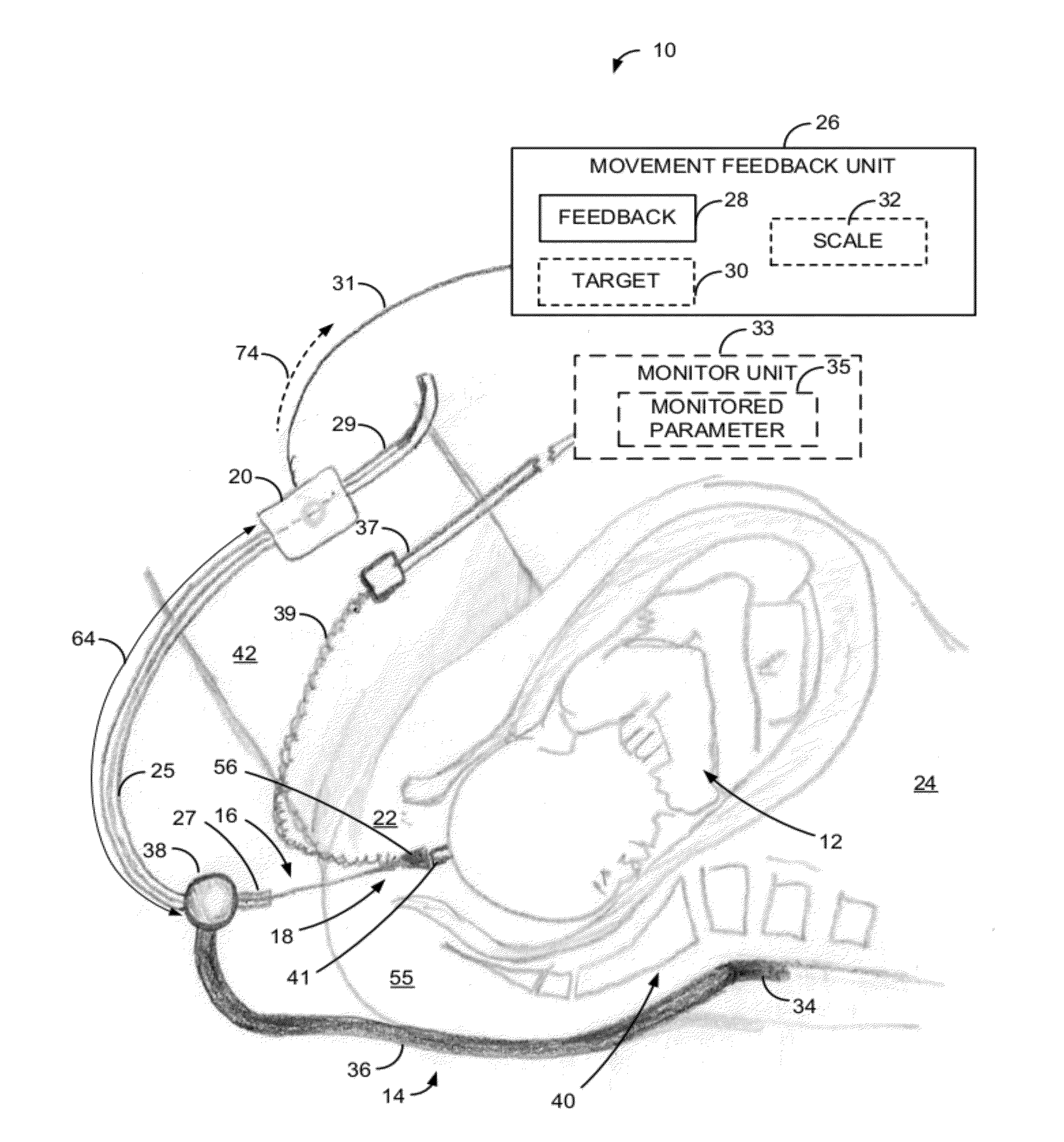 Apparatus and method of detecting movement of objects within the abdominal and/or pelvic region