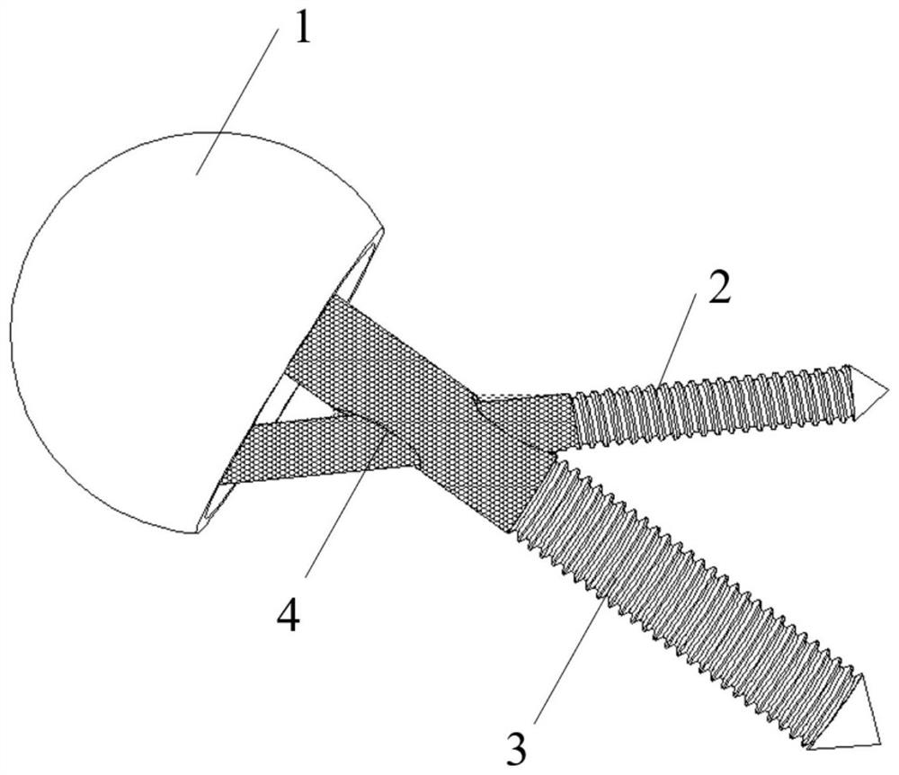 A biomimetic surface hip prosthesis with high long-term stability