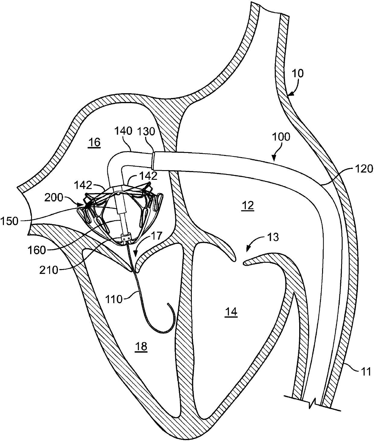 Systems and methods for heart valve therapy