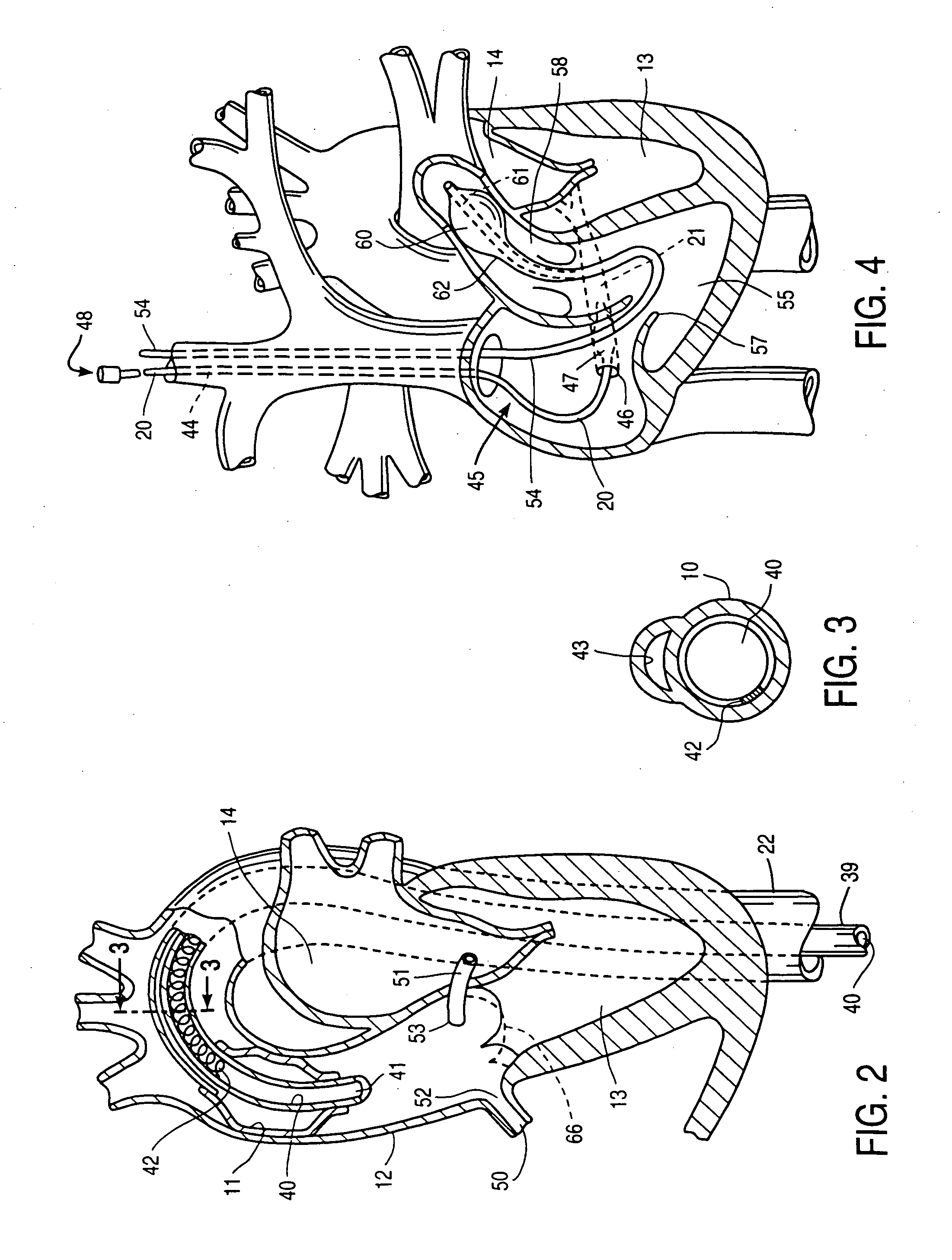 Methods and apparatus for anchoring an occluding member