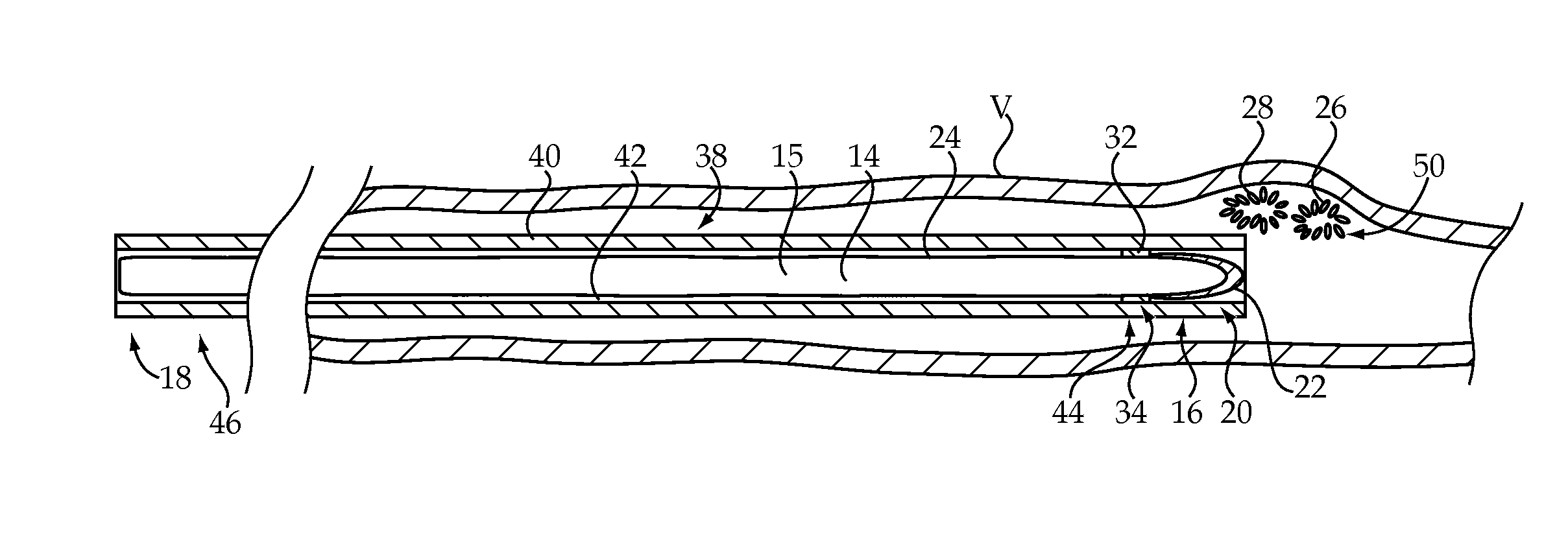Embolic Coil Delivery System