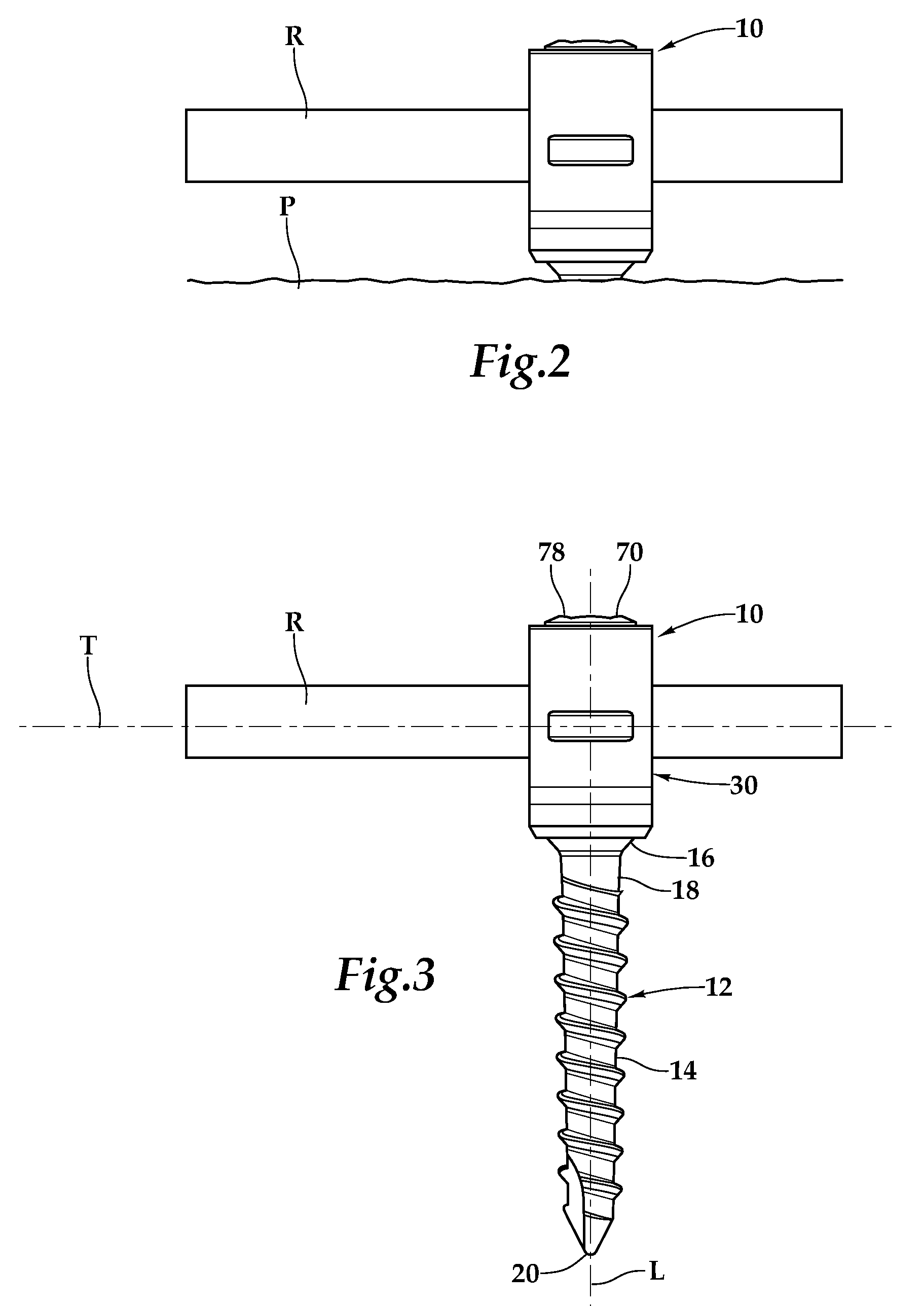 Pedicle Screw Fixation System and Method for Use of Same