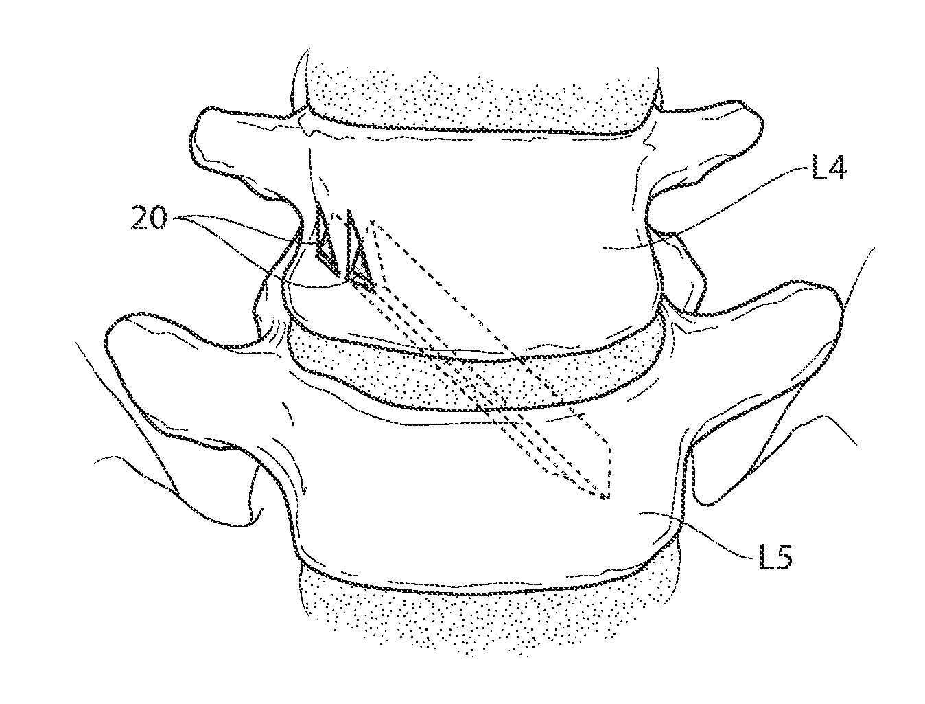 Apparatus, systems, and methods for achieving trans-iliac lumbar fusion