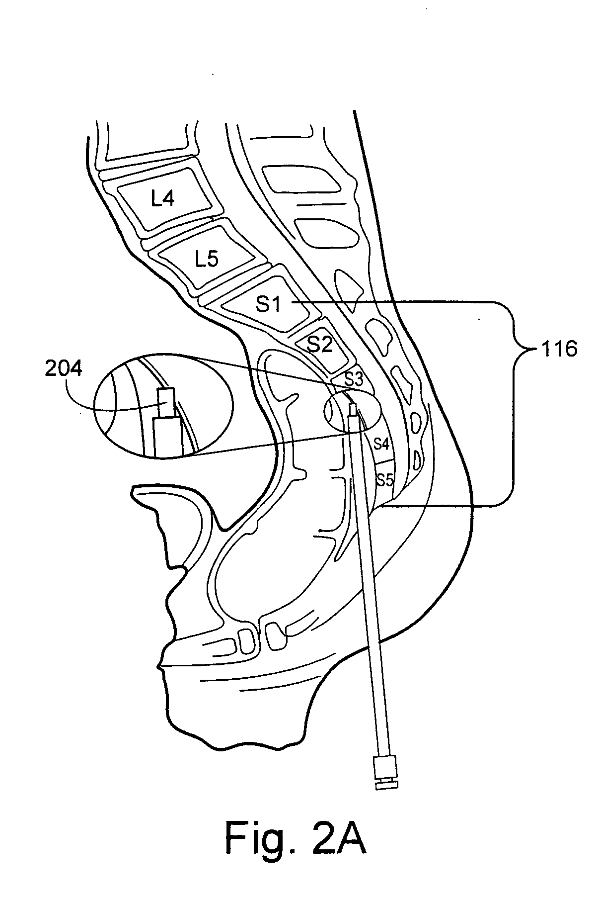 Methods and apparatus for provision of therapy to adjacent motion segments