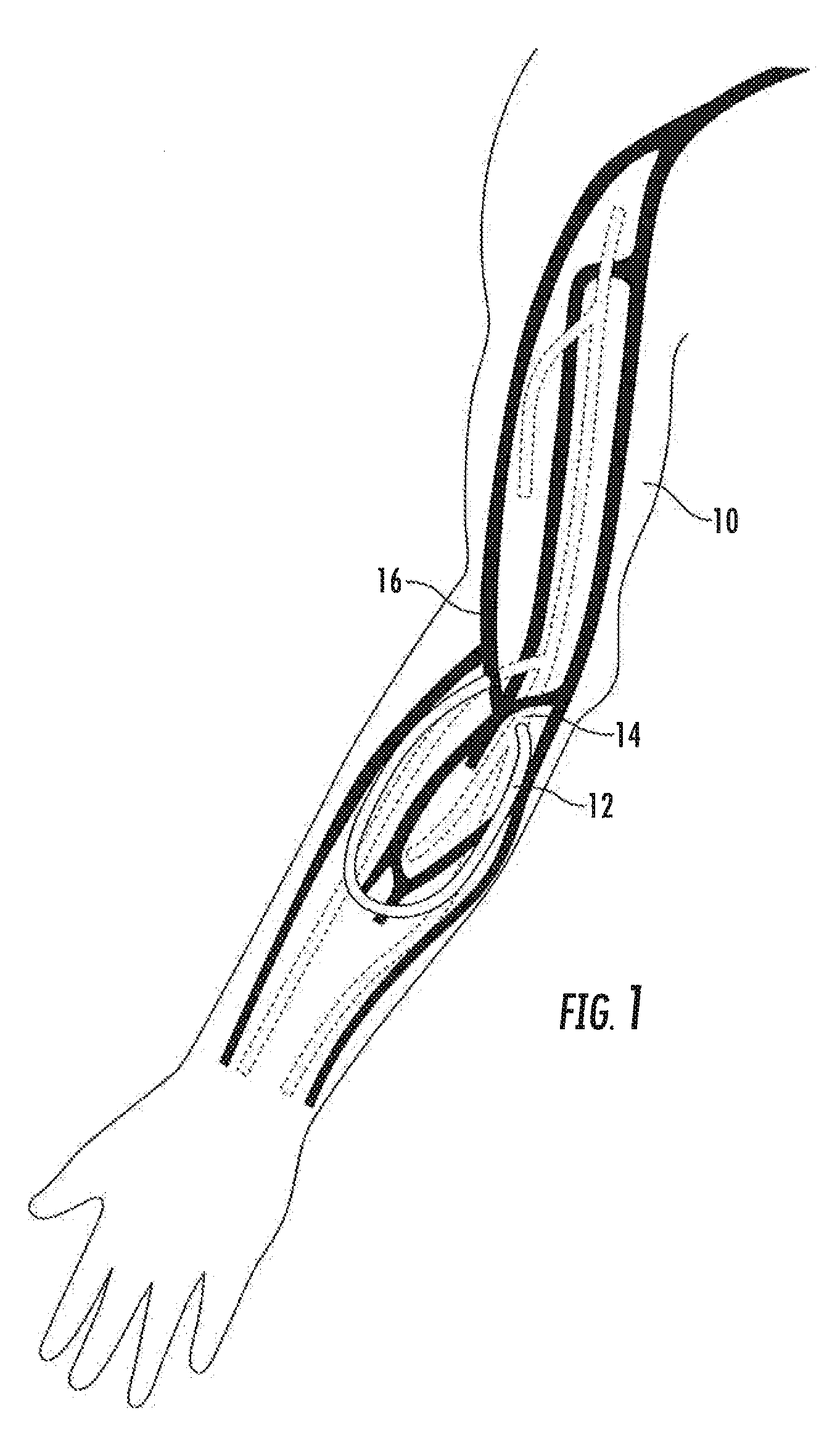 Magnetically activated arteriovenous access valve system and related methods
