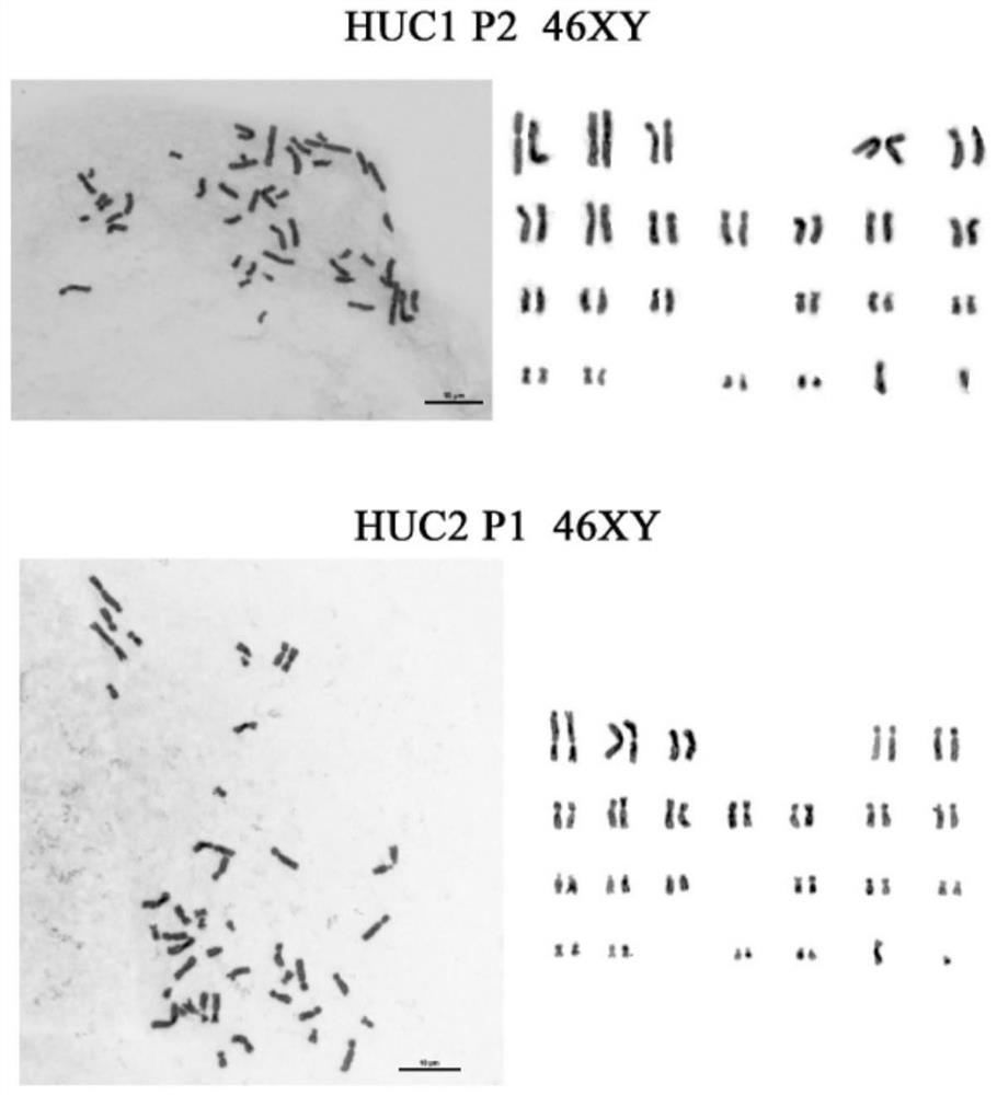 Establishment method of urine cell induced pluripotent stem cells of acute kidney injury patient