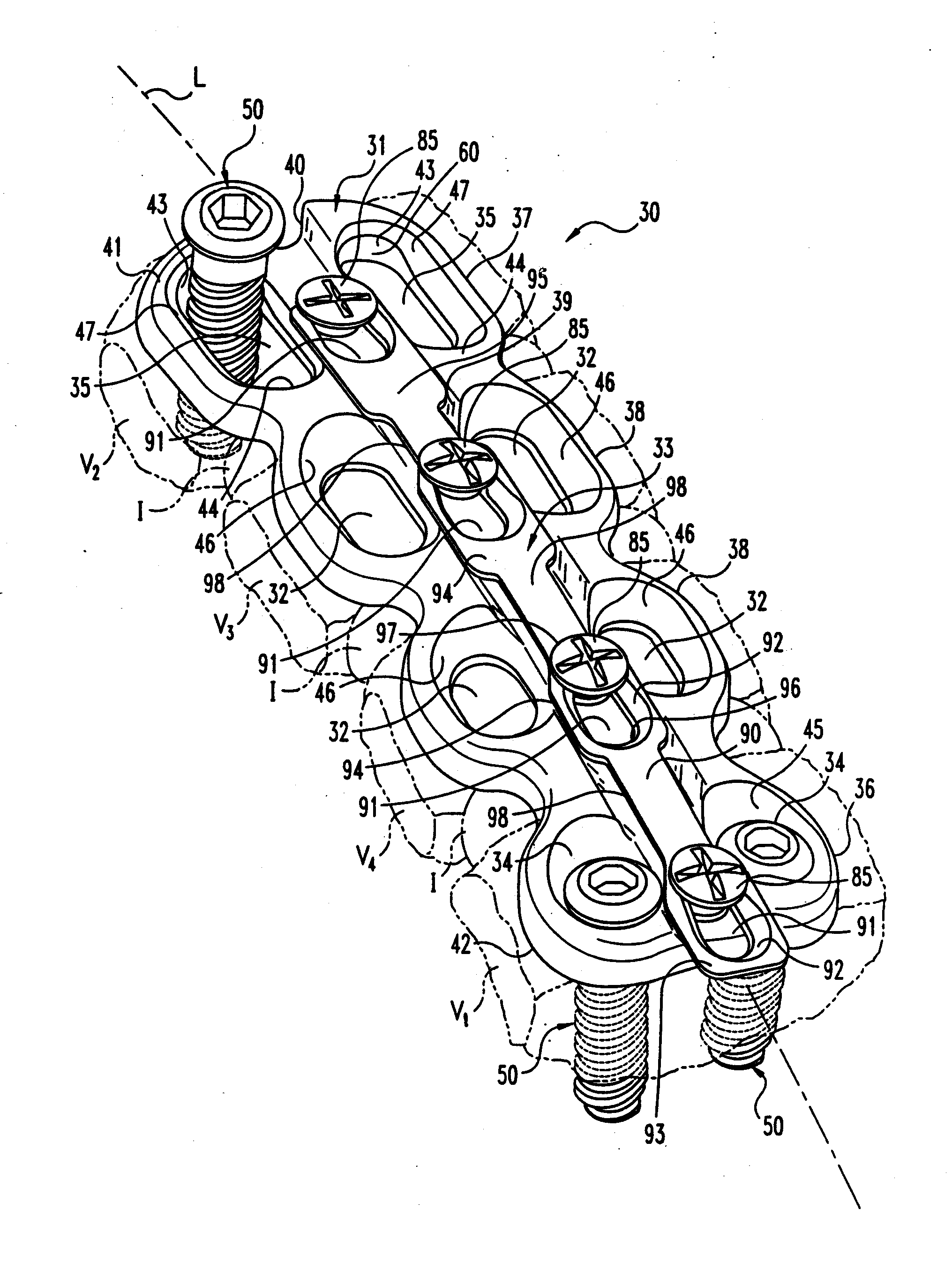 Anterior cervical plating system and method