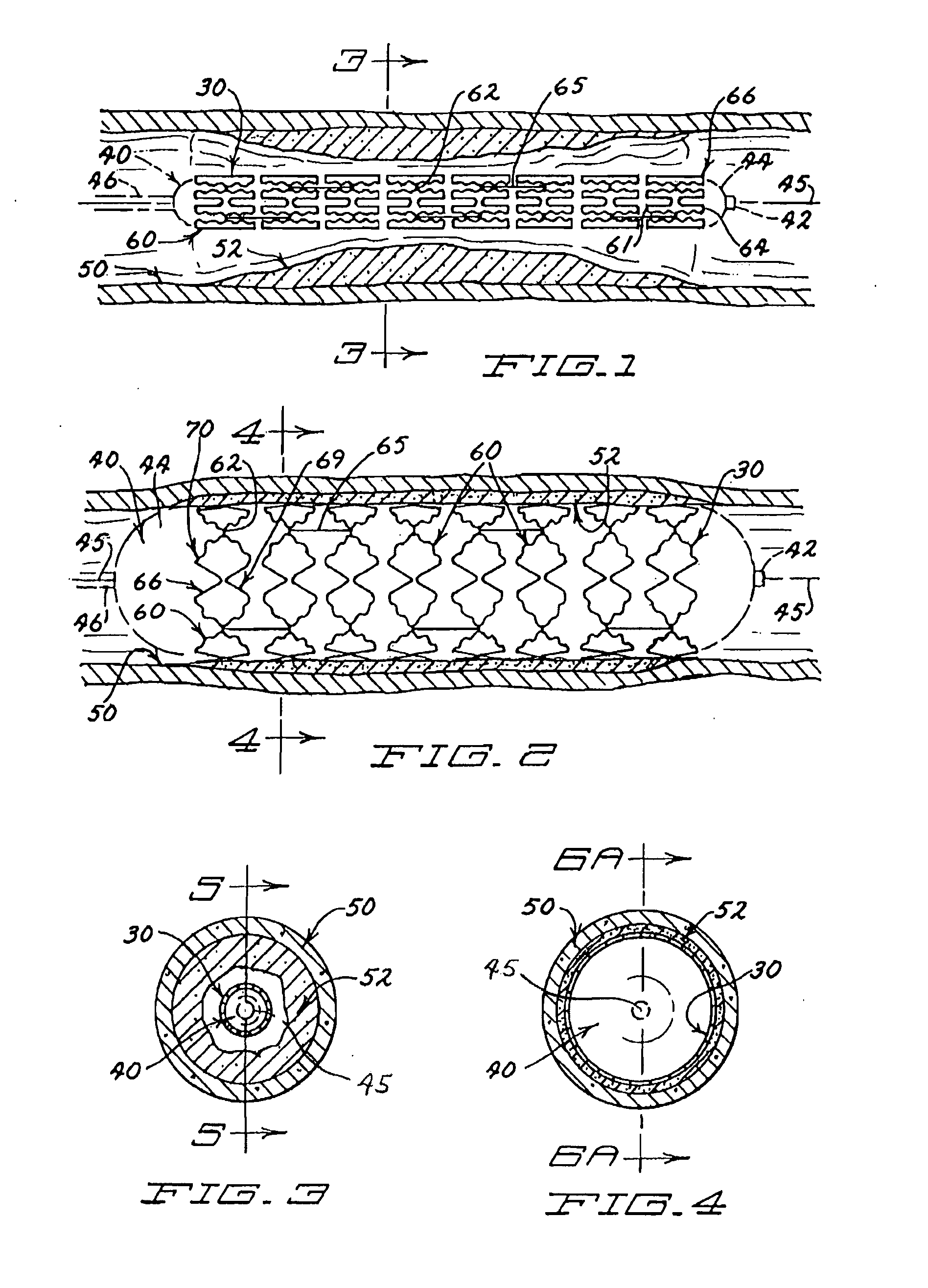 Expandable stent having a plurality of interconnected expansion modules