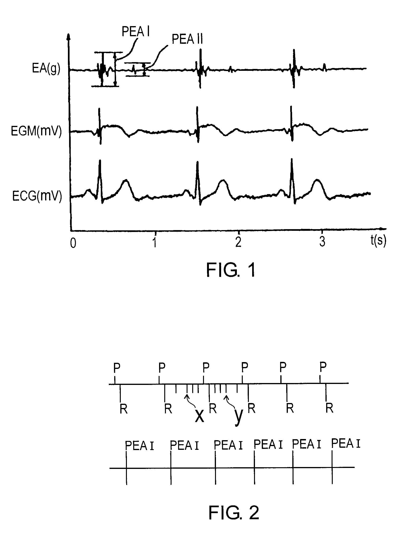 Detecting a lead fracture in an active implantable medical device for cardiac pacing resynchronization cardioversion and/or defibrillation