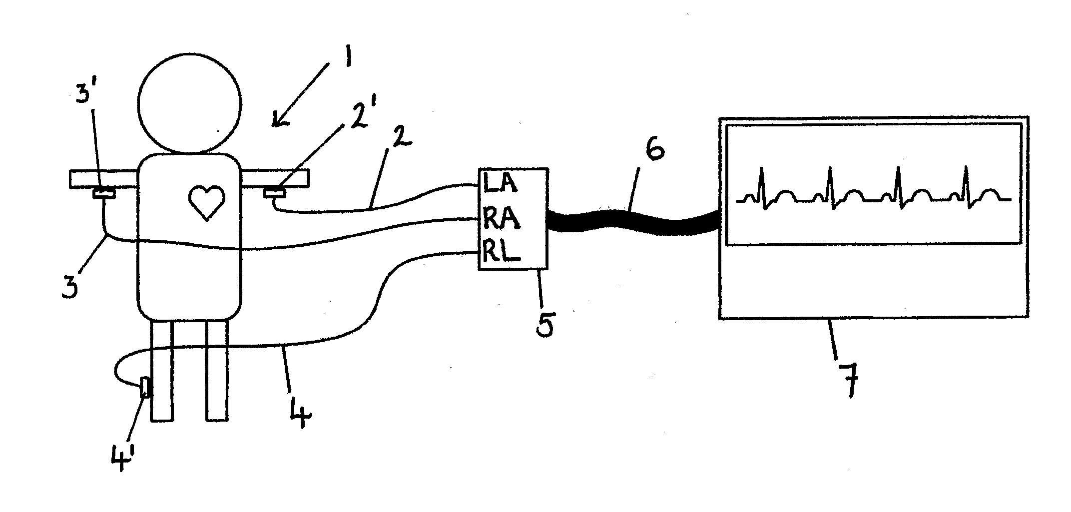 Apparatus for detecting the position of a percutaneously-inserted intravenous catheter