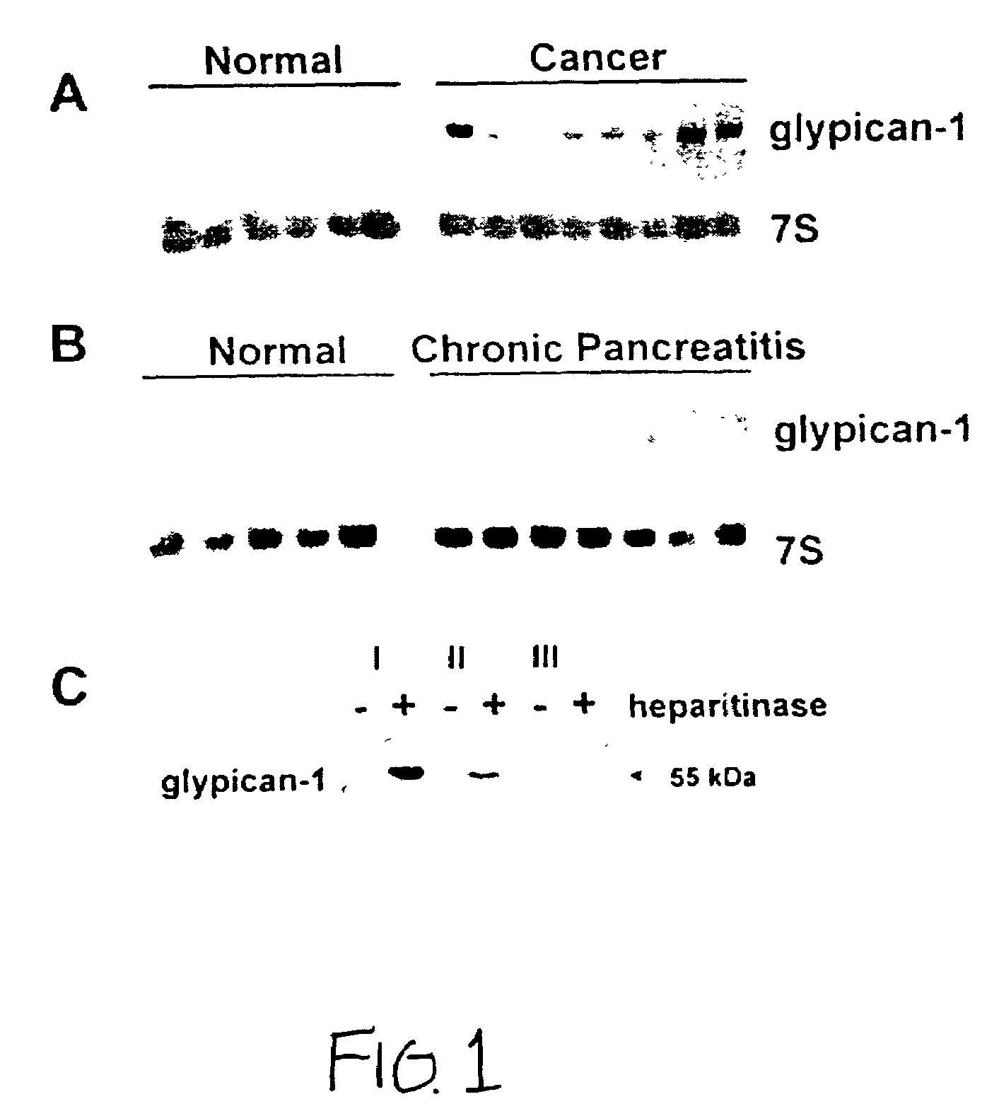 Glypican-1 in human breast cancer