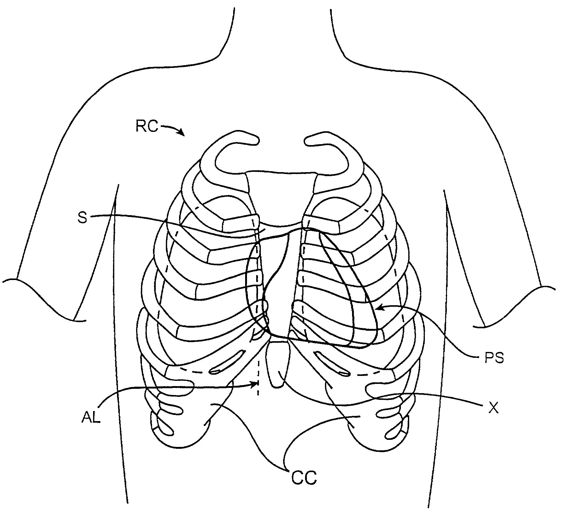 Methods and apparatus for transpericardial left atrial appendage closure