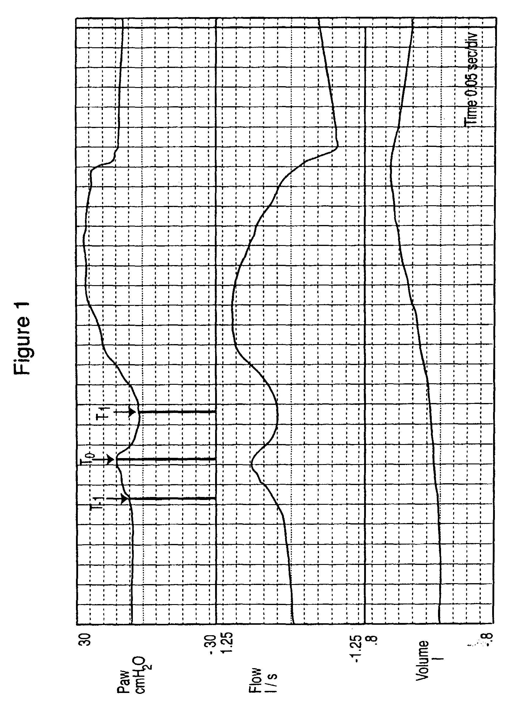 Method and apparatus for determining respiratory system resistance during assisted ventilation