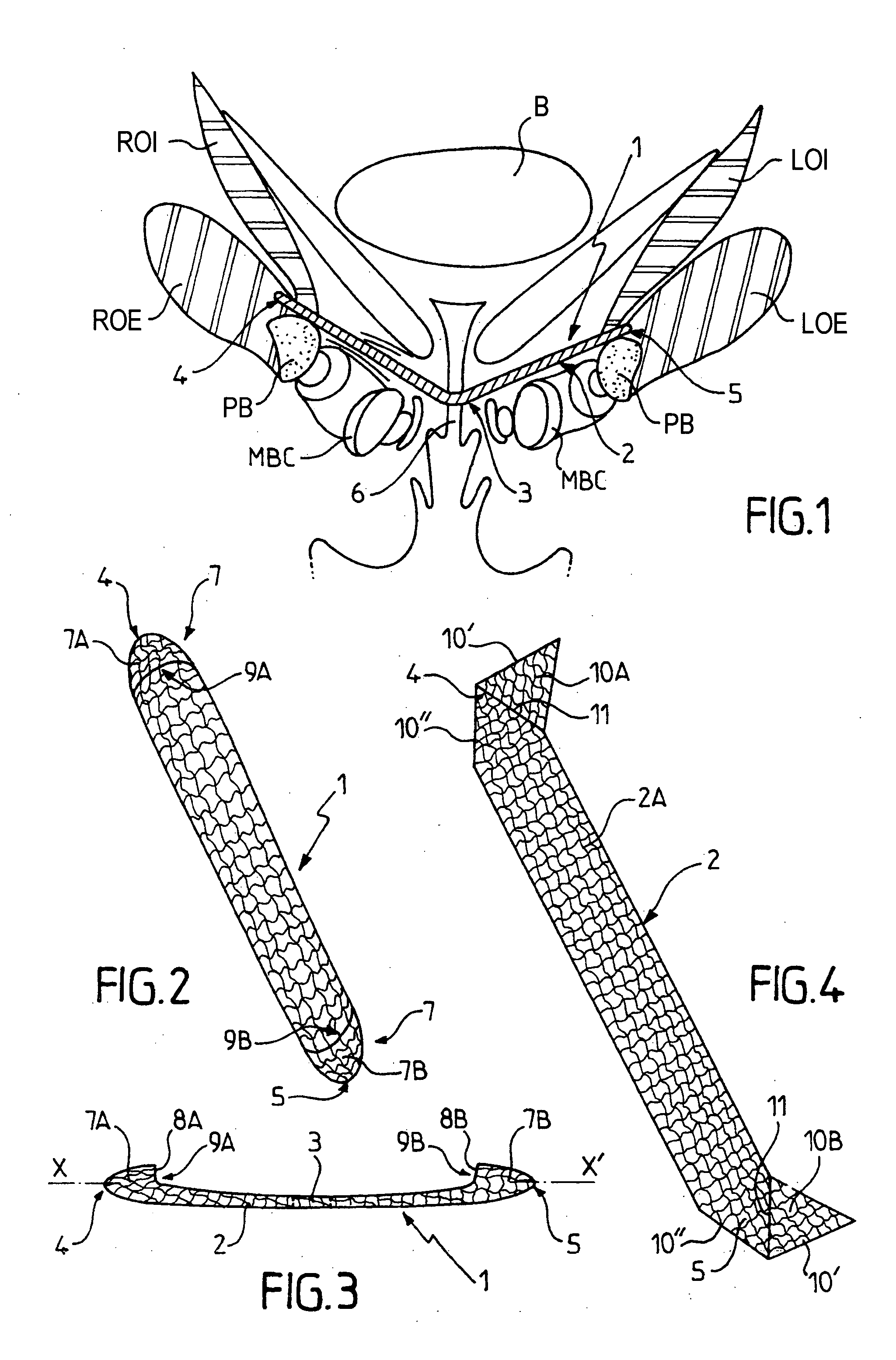 Prosthetic implant for sub-urethral support, an instrument, an insertion kit, and a surgical method for implanting it