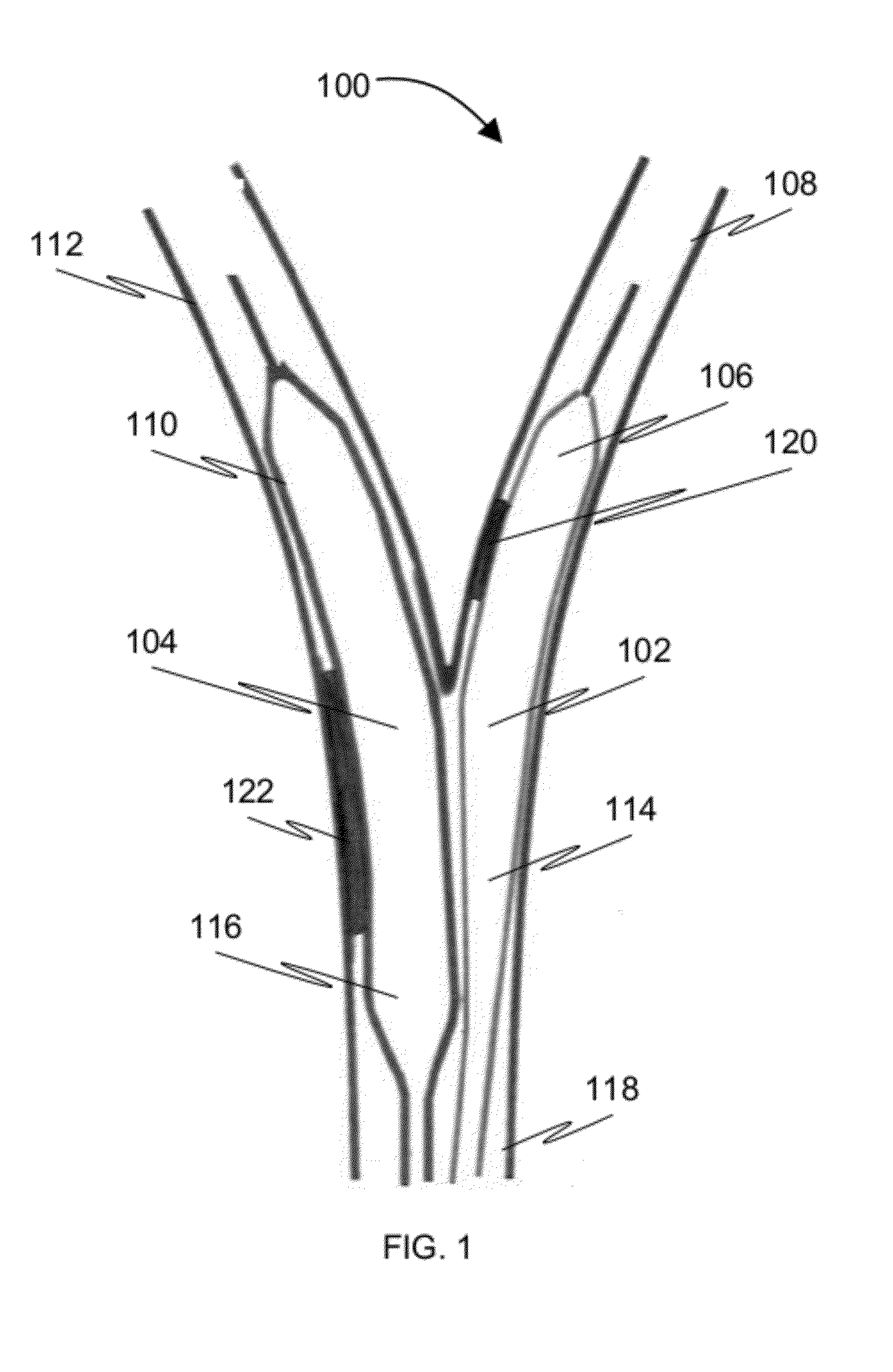 Method and a balloon catheter assembly for treating bifurcation lesions