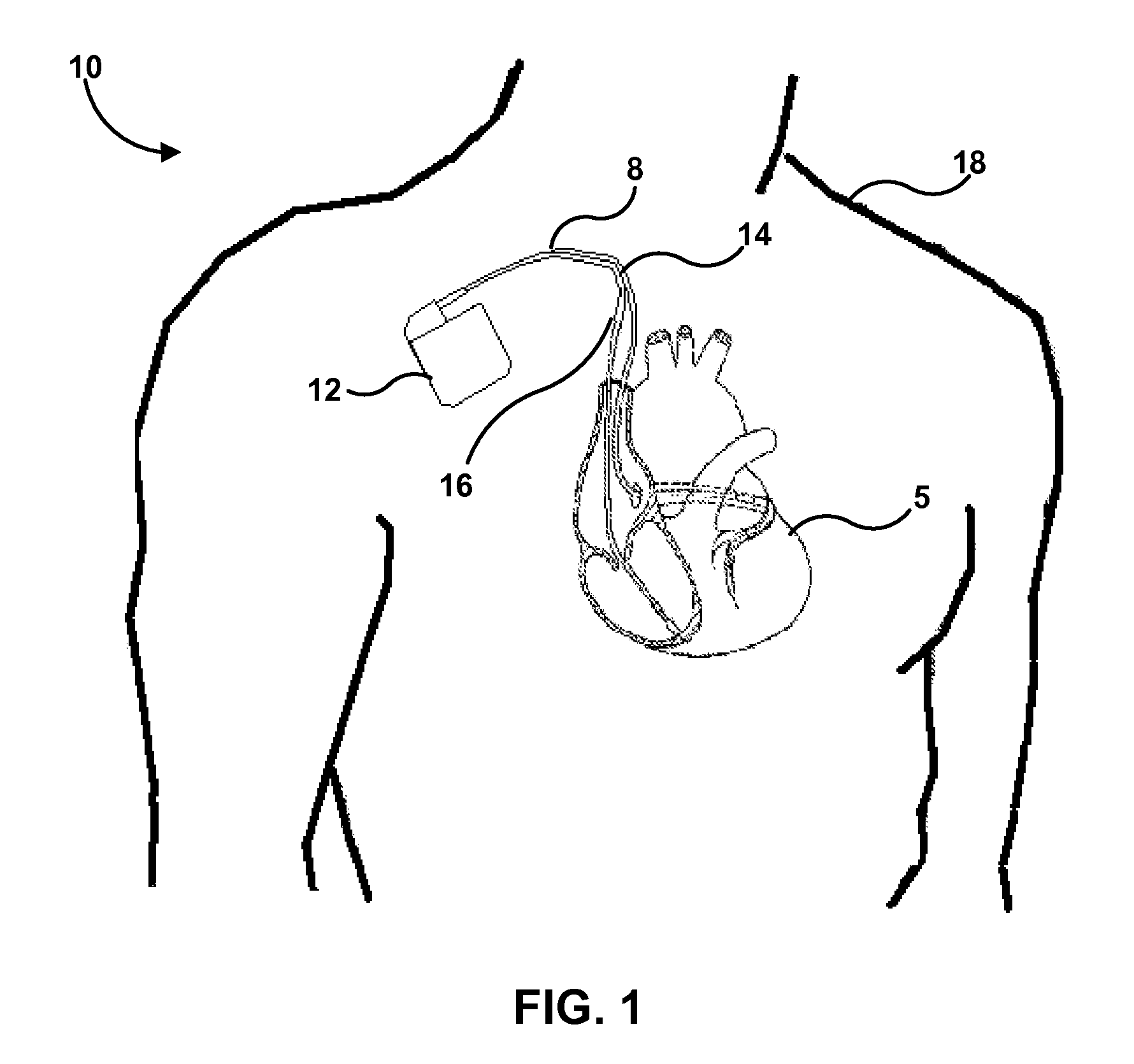 Implantable medical lead with biased electrode