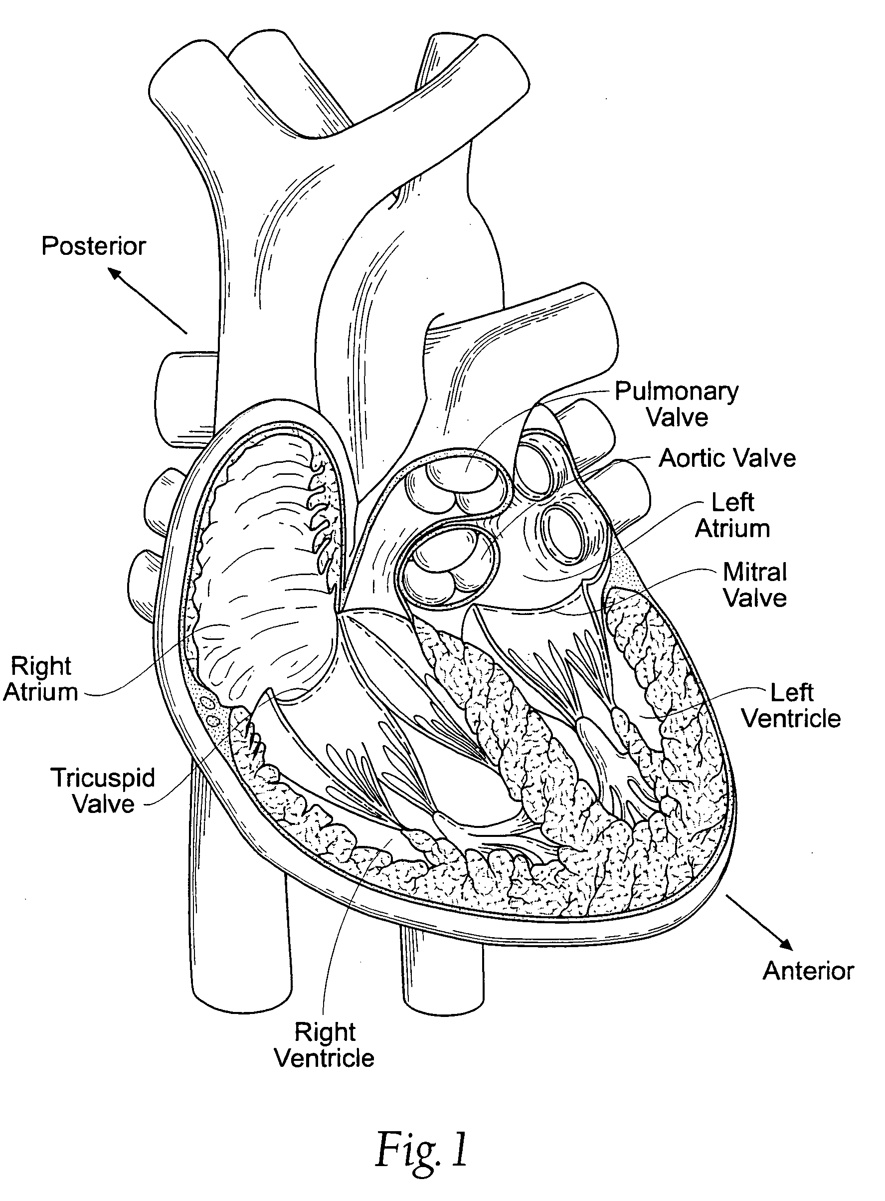 Devices, systems, and methods for reshaping a heart valve annulus, including the use of magnetic tools