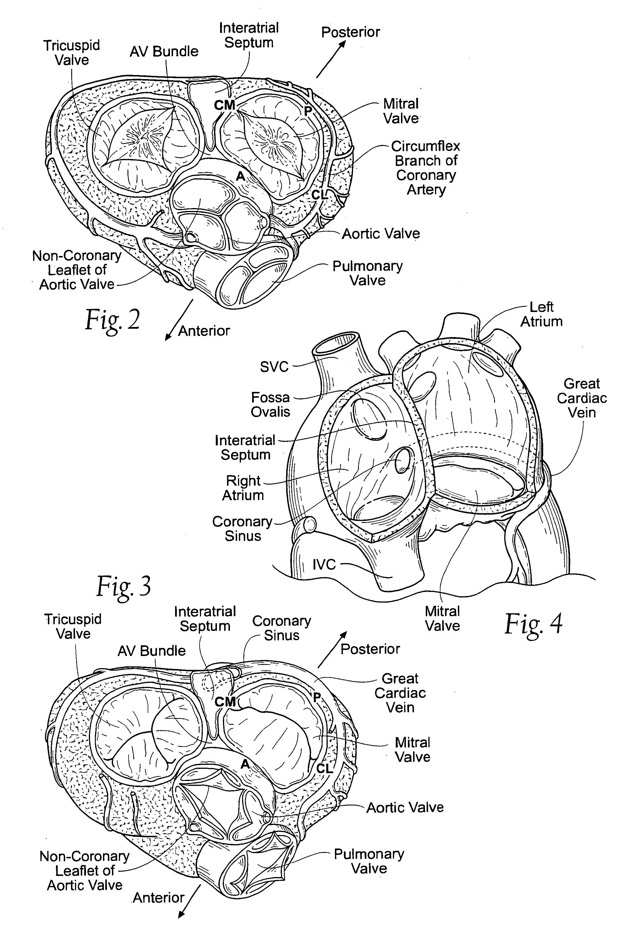 Devices, systems, and methods for reshaping a heart valve annulus, including the use of magnetic tools