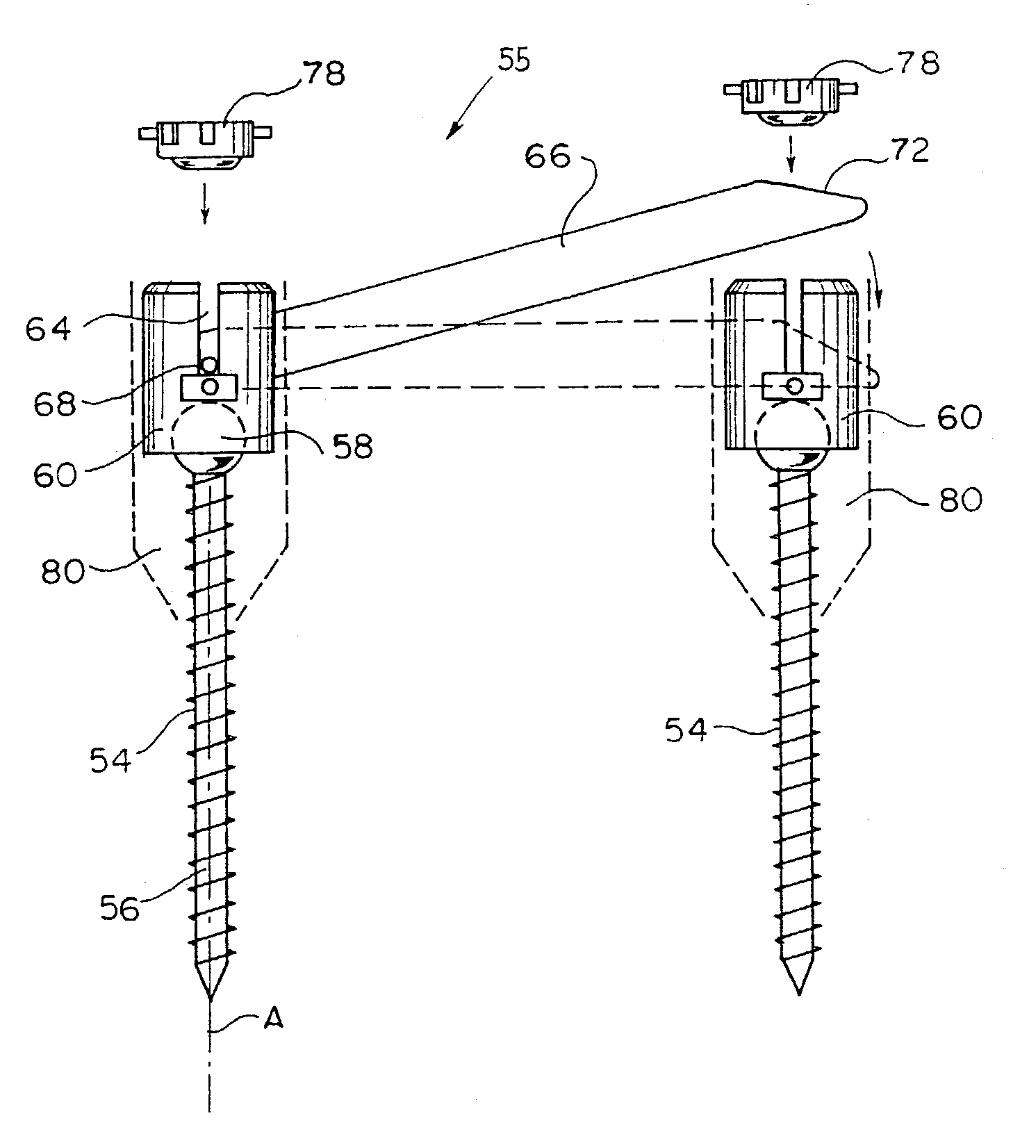 Device and method for percutaneous placement of lumbar pedicle screws and connecting rods