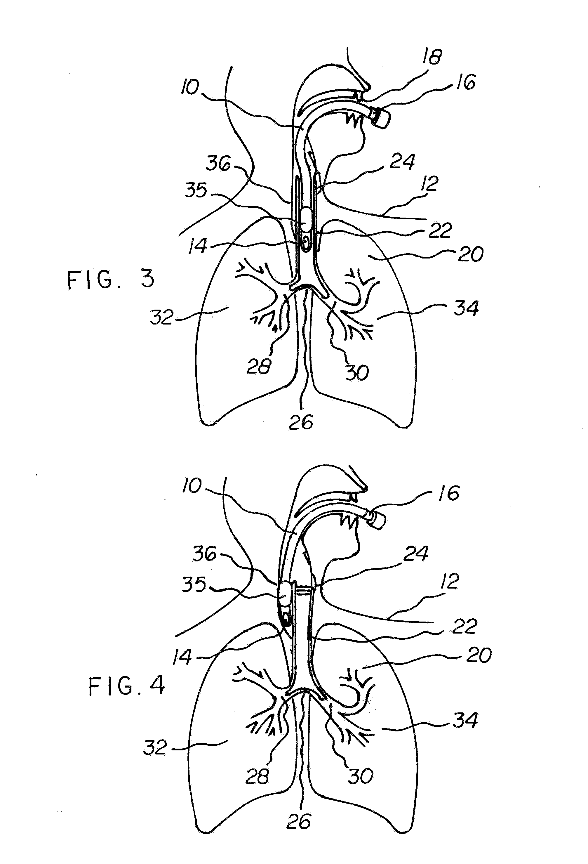 Leak detection system and method for tube or catheter placement