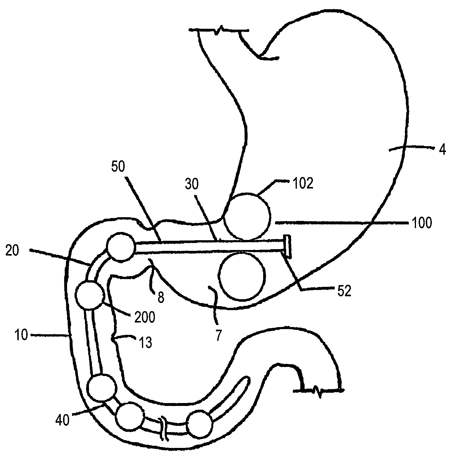 Conformationally-stabilized intraluminal device for medical applications