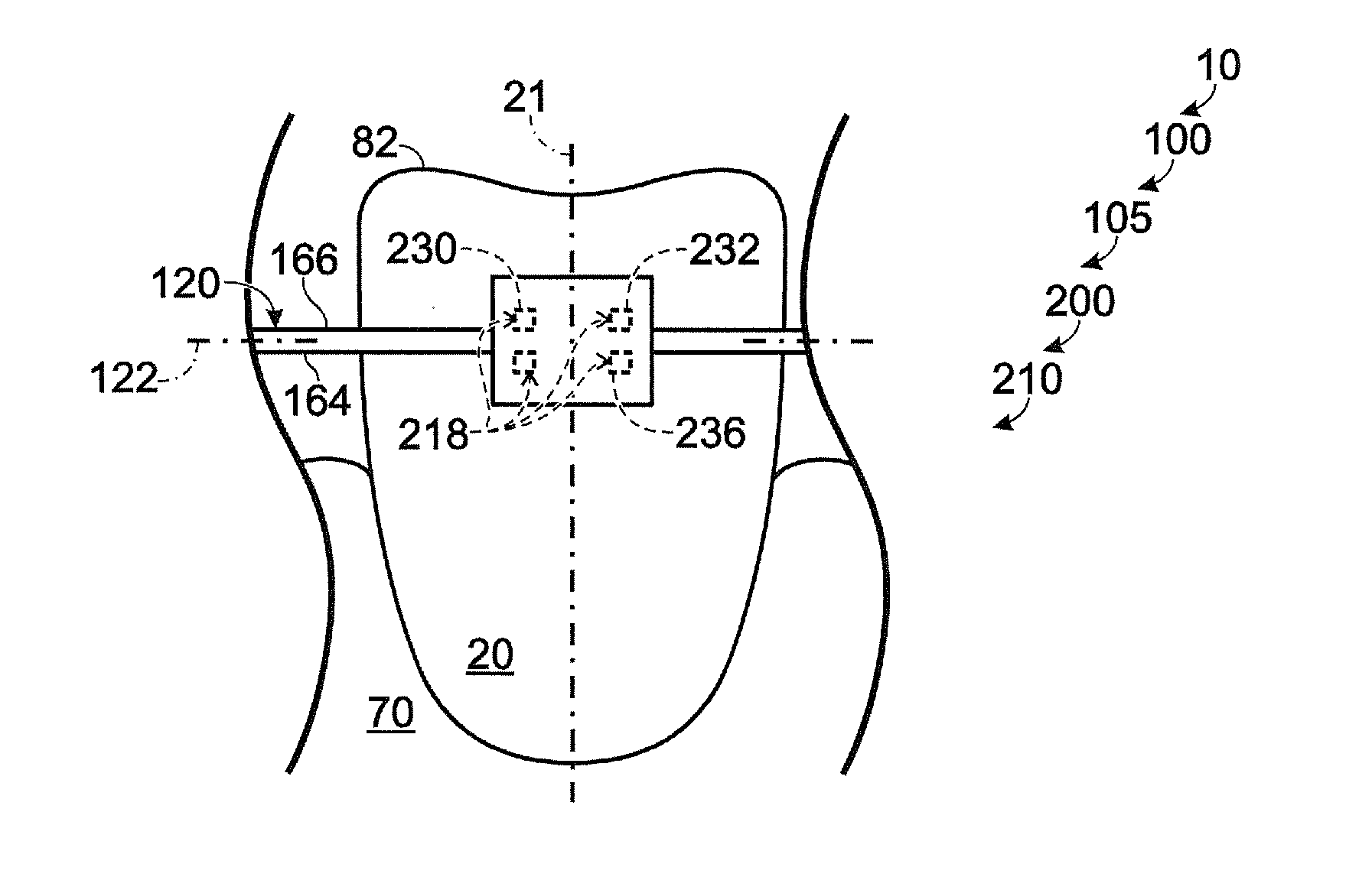 Prescription-altering accessories for orthodontic brackets, and orthodontic bracket assemblies including the same