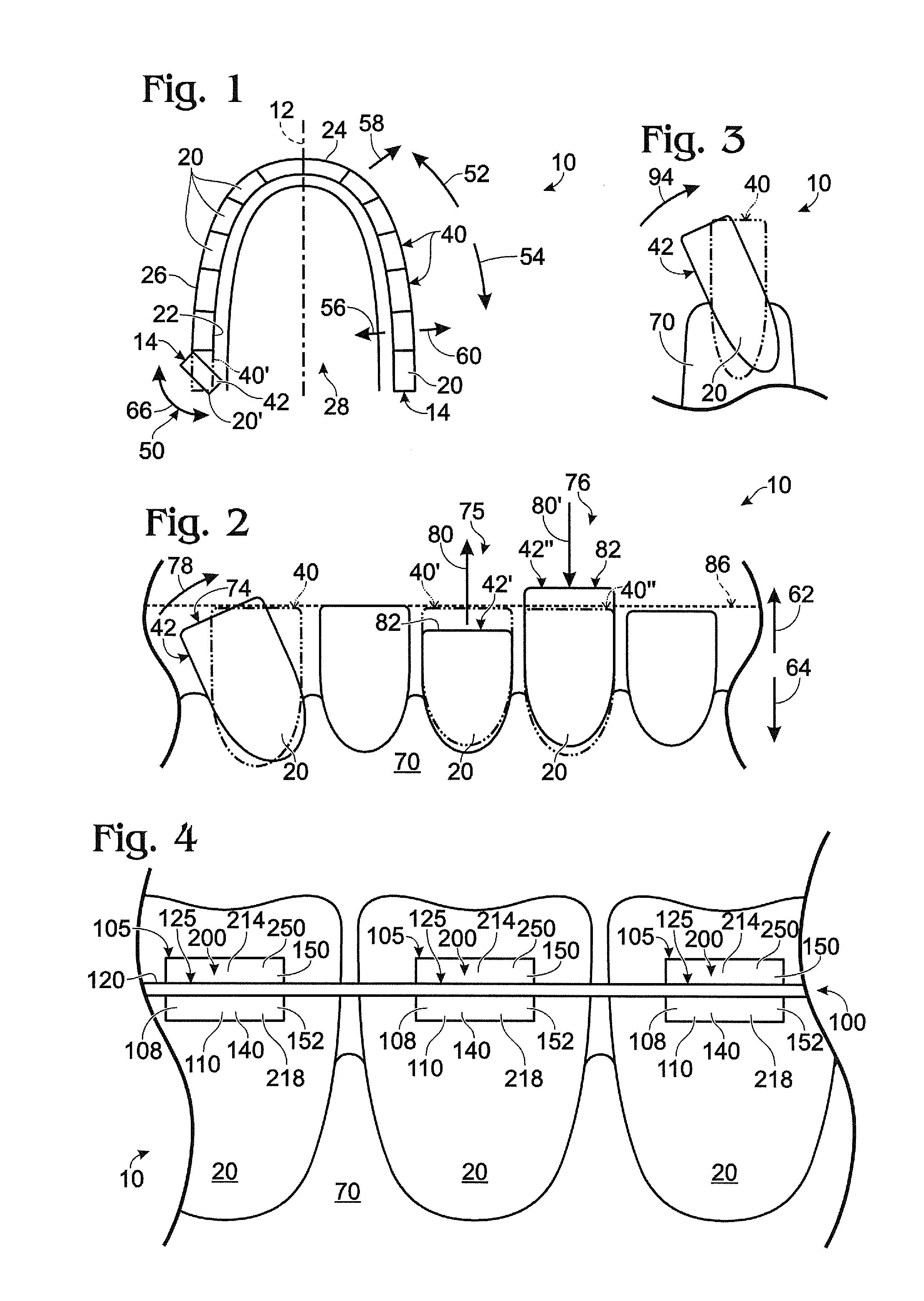 Prescription-altering accessories for orthodontic brackets, and orthodontic bracket assemblies including the same