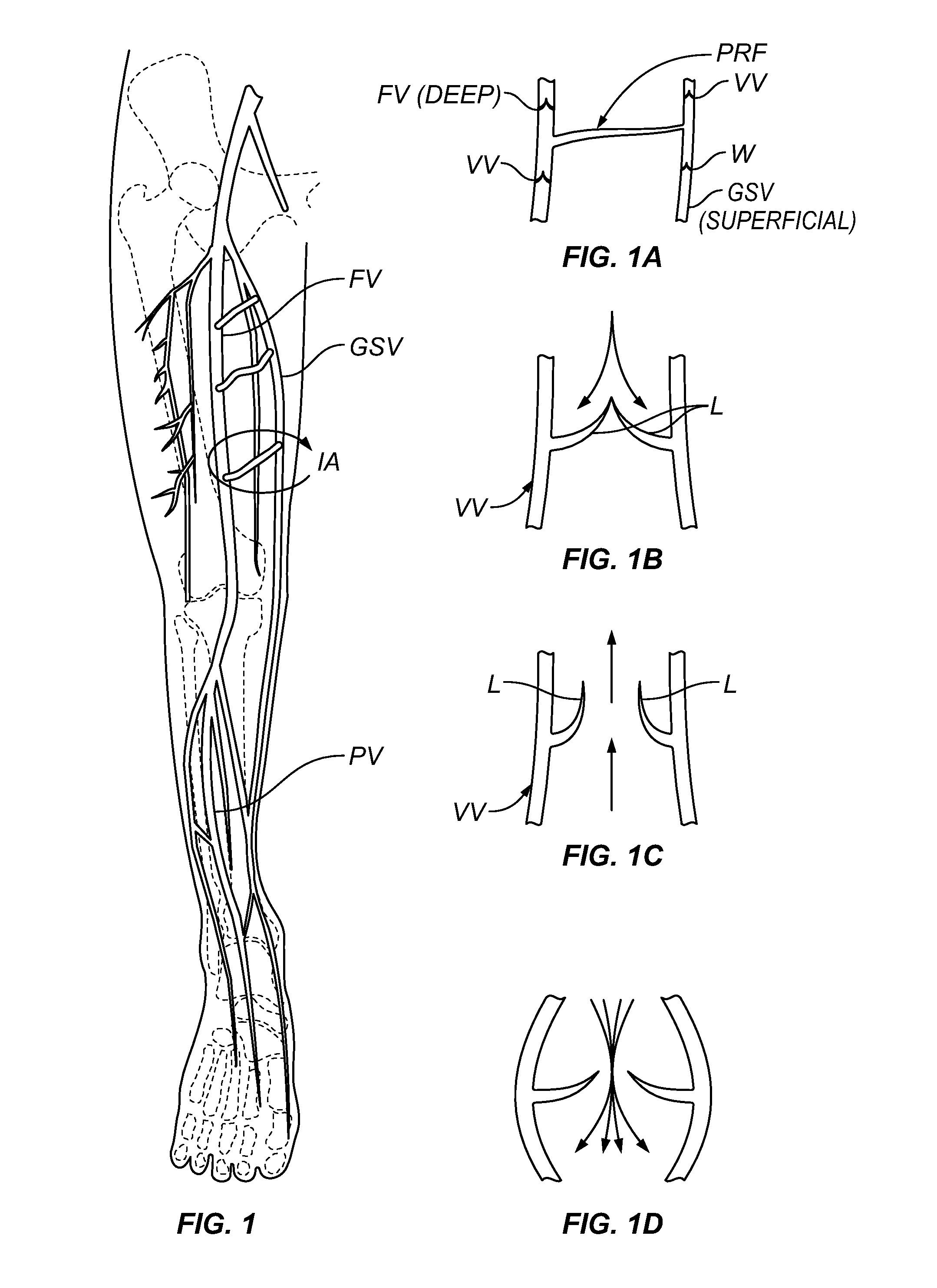 Methods, Devices and Systems for Treating Venous Insufficiency