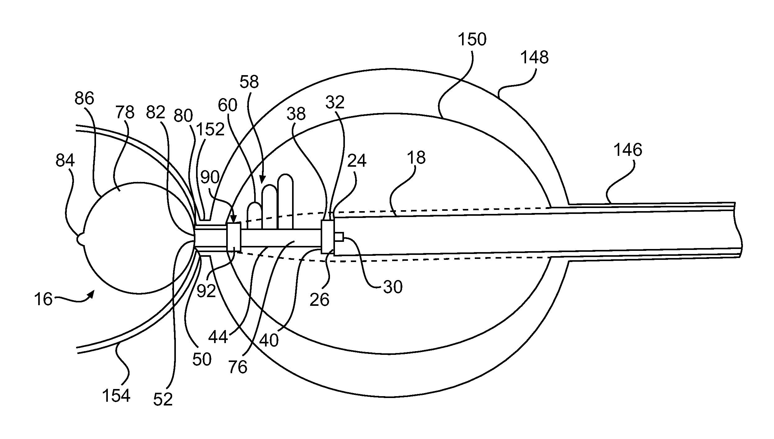 Devices and methods for prostate tissue ablation and/or resection