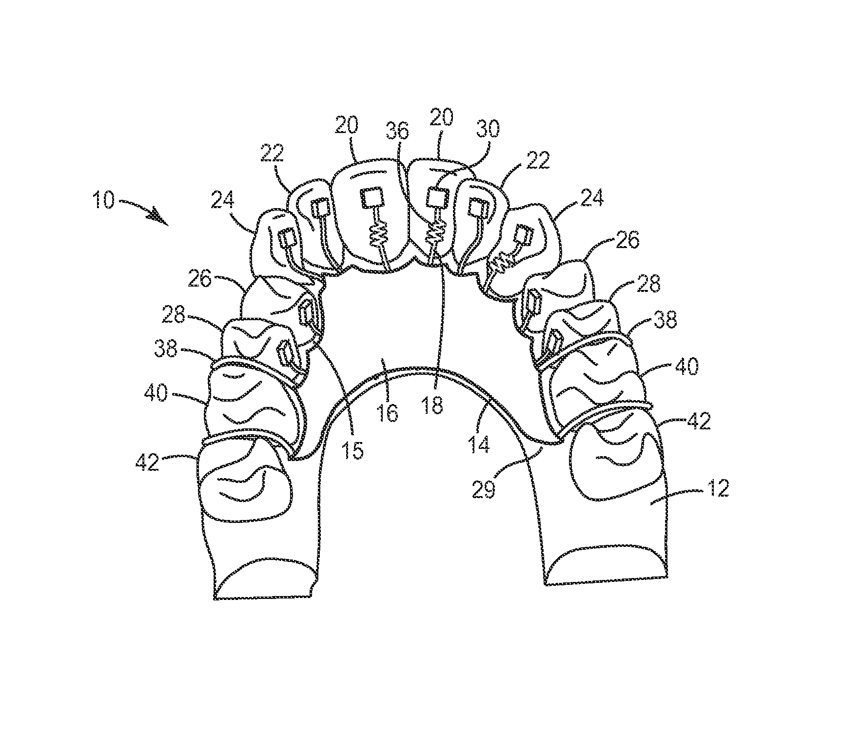 Lingual orthodontic appliance with removable section