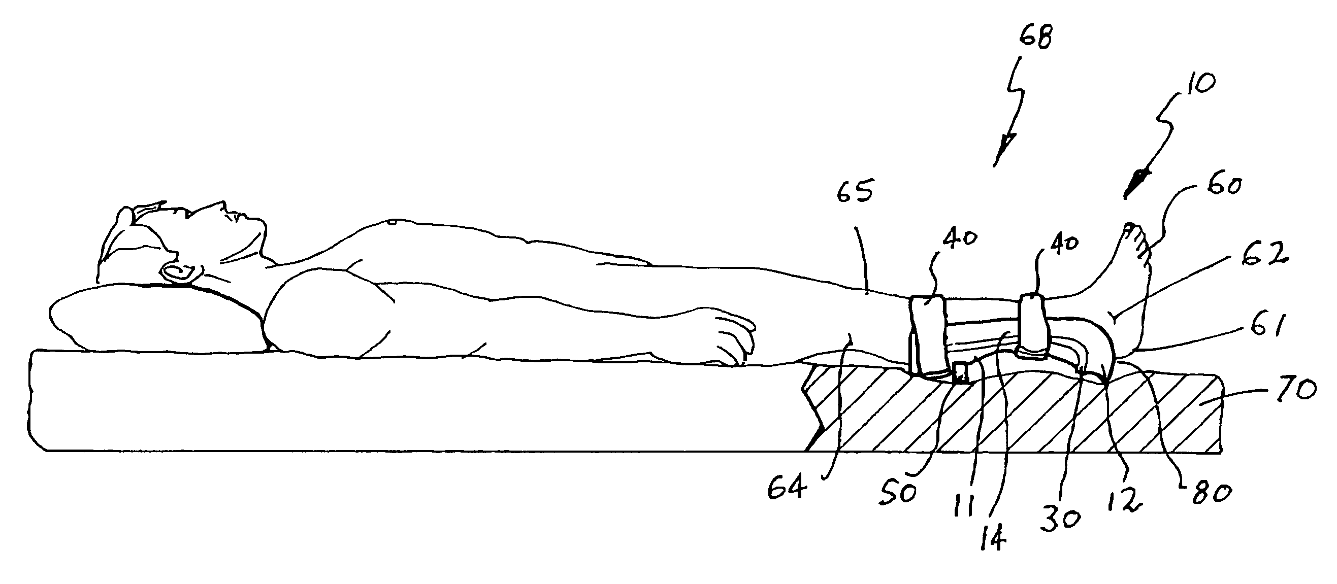 Pressure ulcer prosthesis and method for treating and/or preventing pressure ulcers