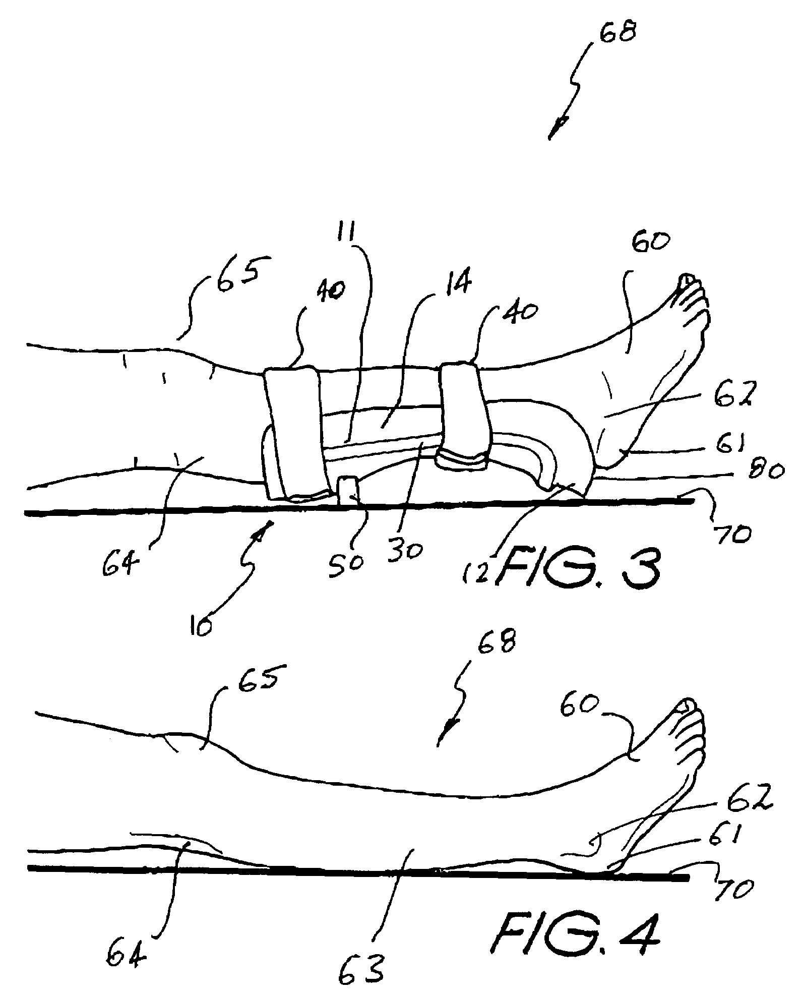 Pressure ulcer prosthesis and method for treating and/or preventing pressure ulcers